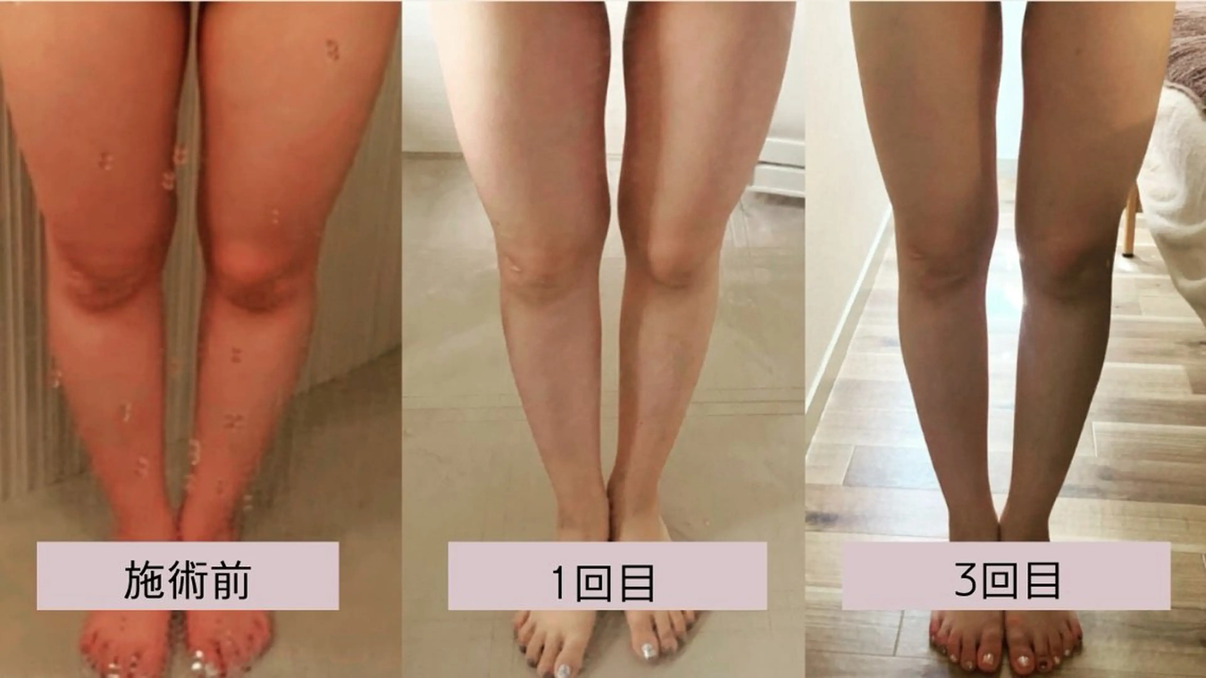 【下半身・痩身コース】お尻・太もも・ふくらはぎ　うつ伏せ送信＊ミニモ限定／凸凹セルへピンポイントアプローチ！の写真