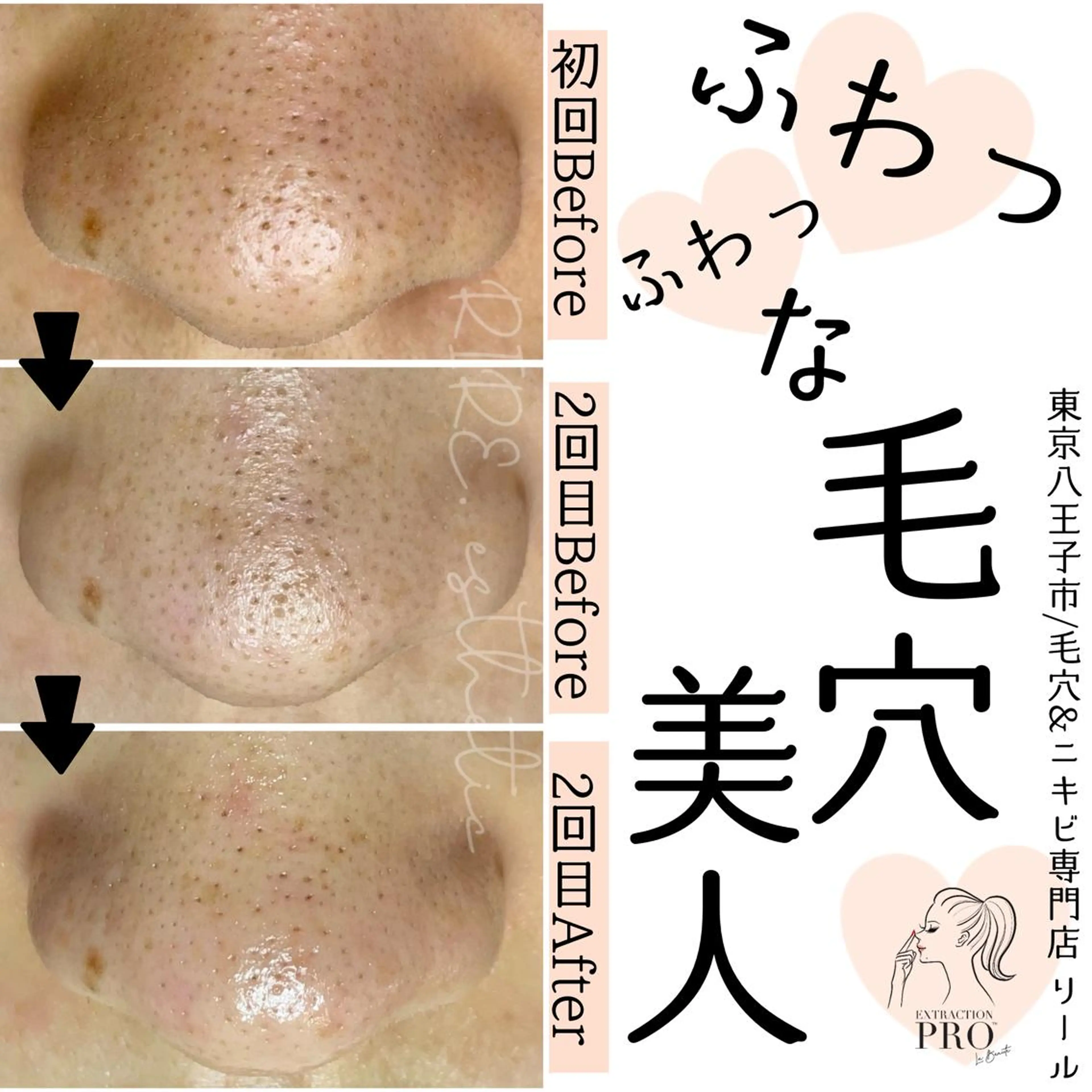 毛穴特化エステ -リールのエステ・リラクイメージ