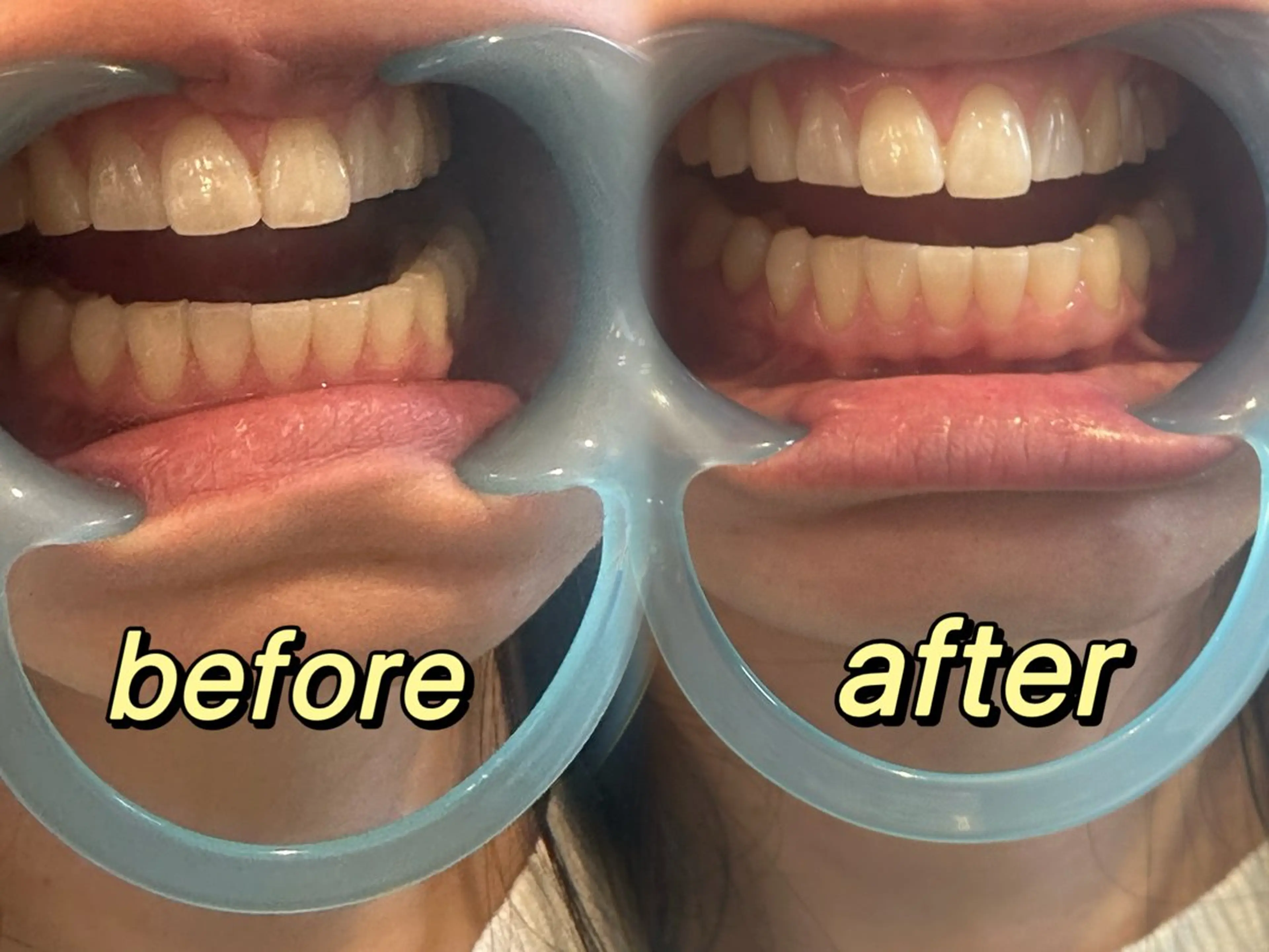 【🦷美歯口ホワイトニング 🦷 】の写真