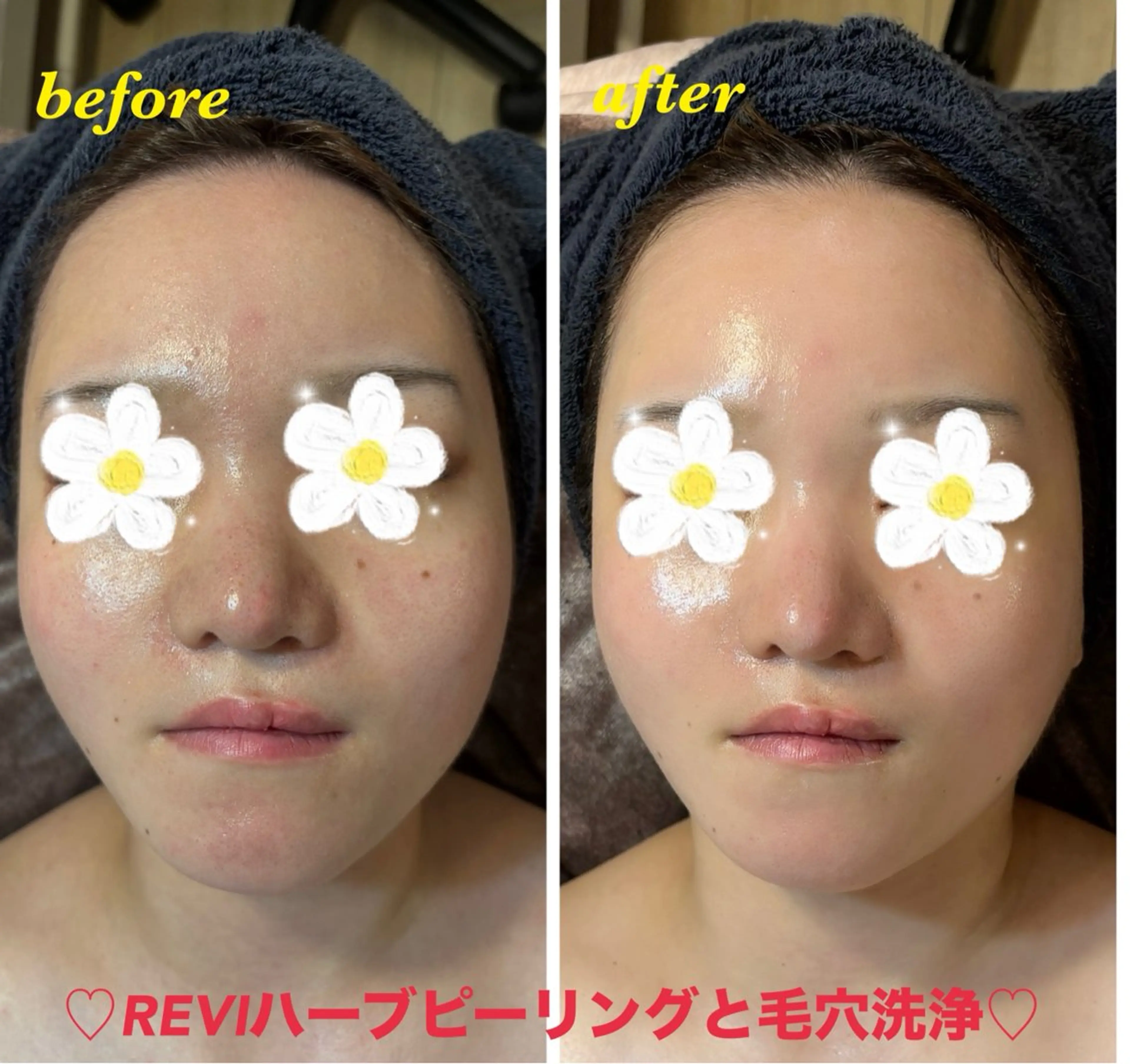 エステ ハーブピーリング専門 毛穴洗浄❤️眉waxのエステ・リラクイメージ