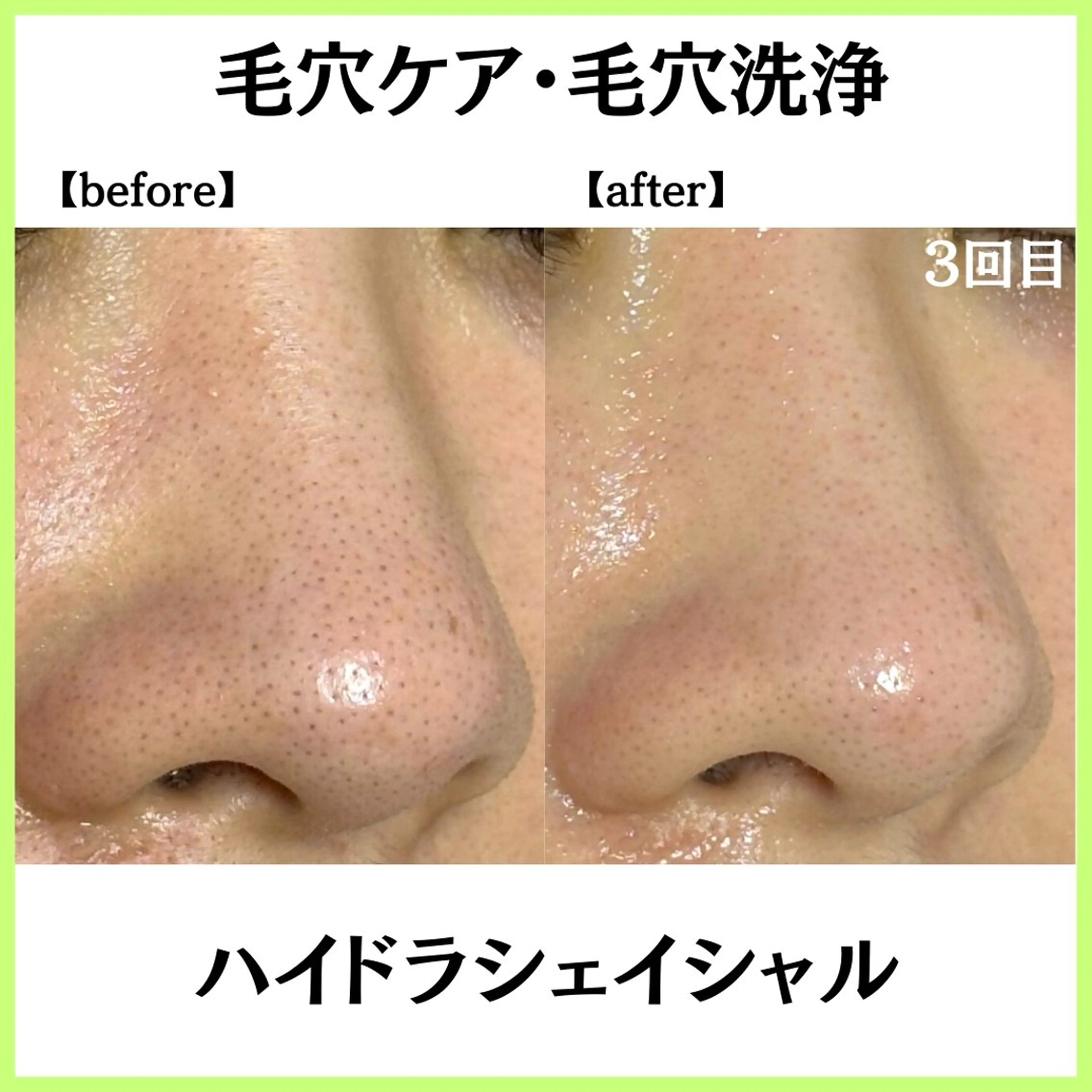 小顔ハーブピーリング 美容鍼/毛穴洗浄のエステ・リラクイメージ