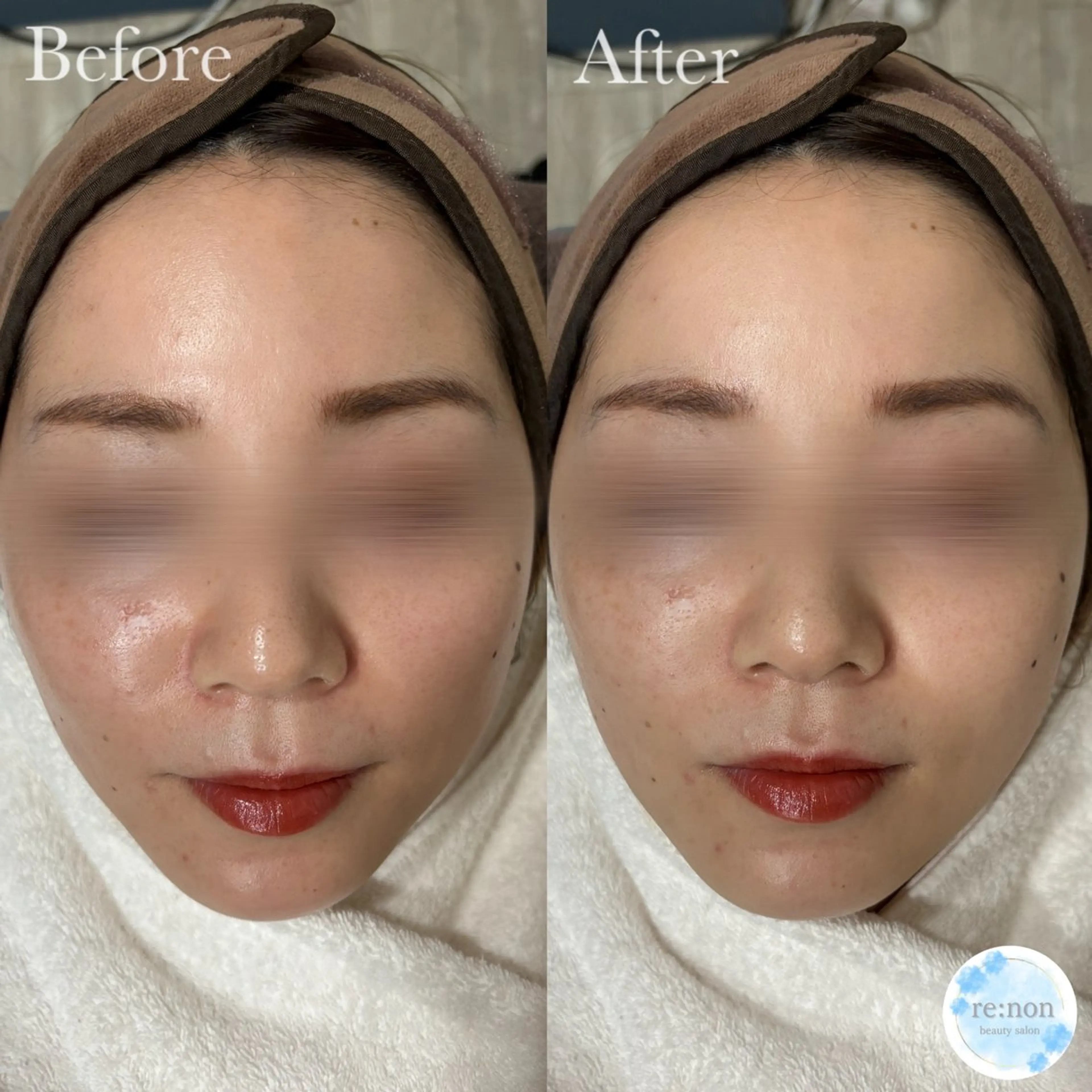 美容鍼脱毛salon リノン吹田駅前店のエステ・リラクイメージ