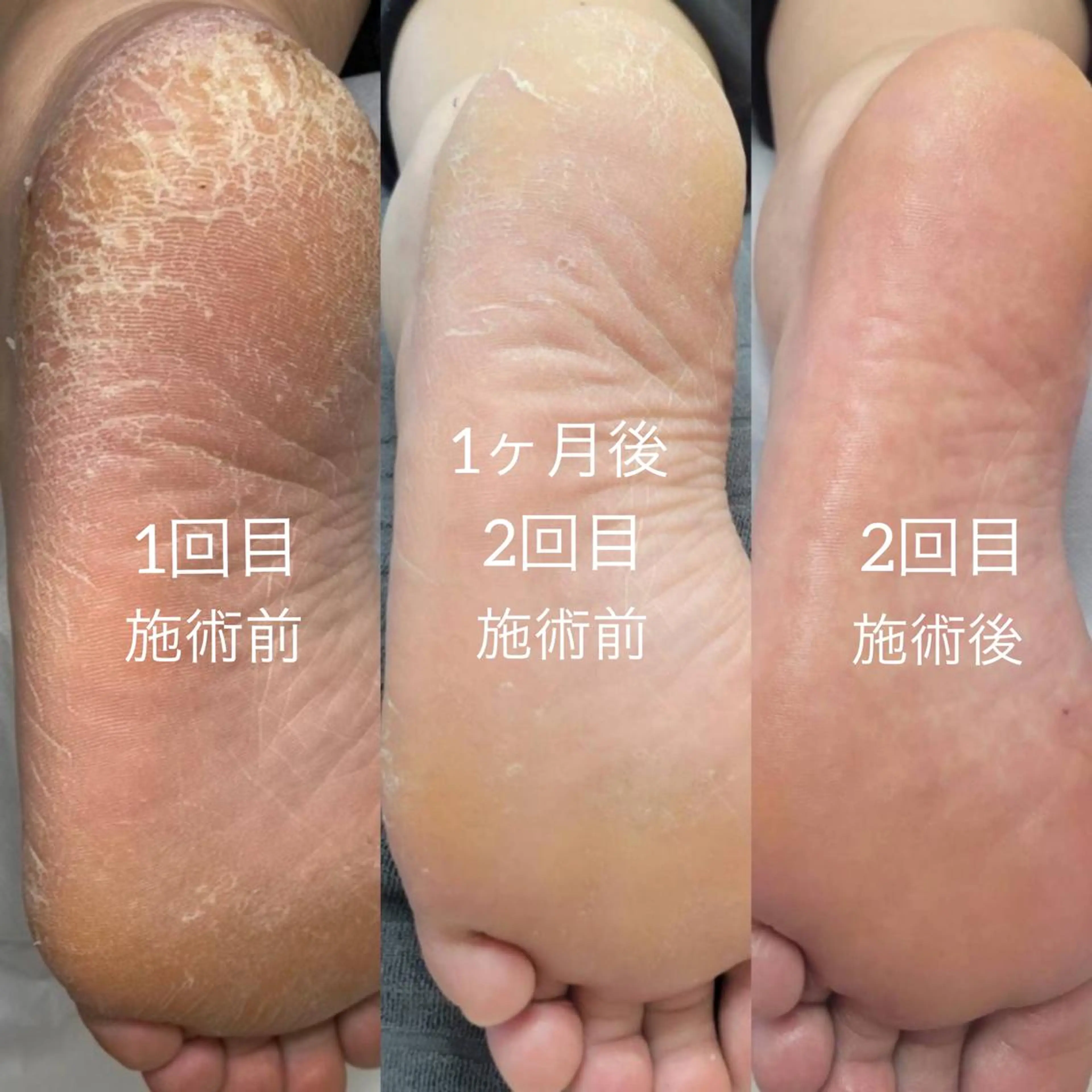 常識をくつがえす新しい角質ケア！！『エンザイム角質ビットケア®︎』の写真