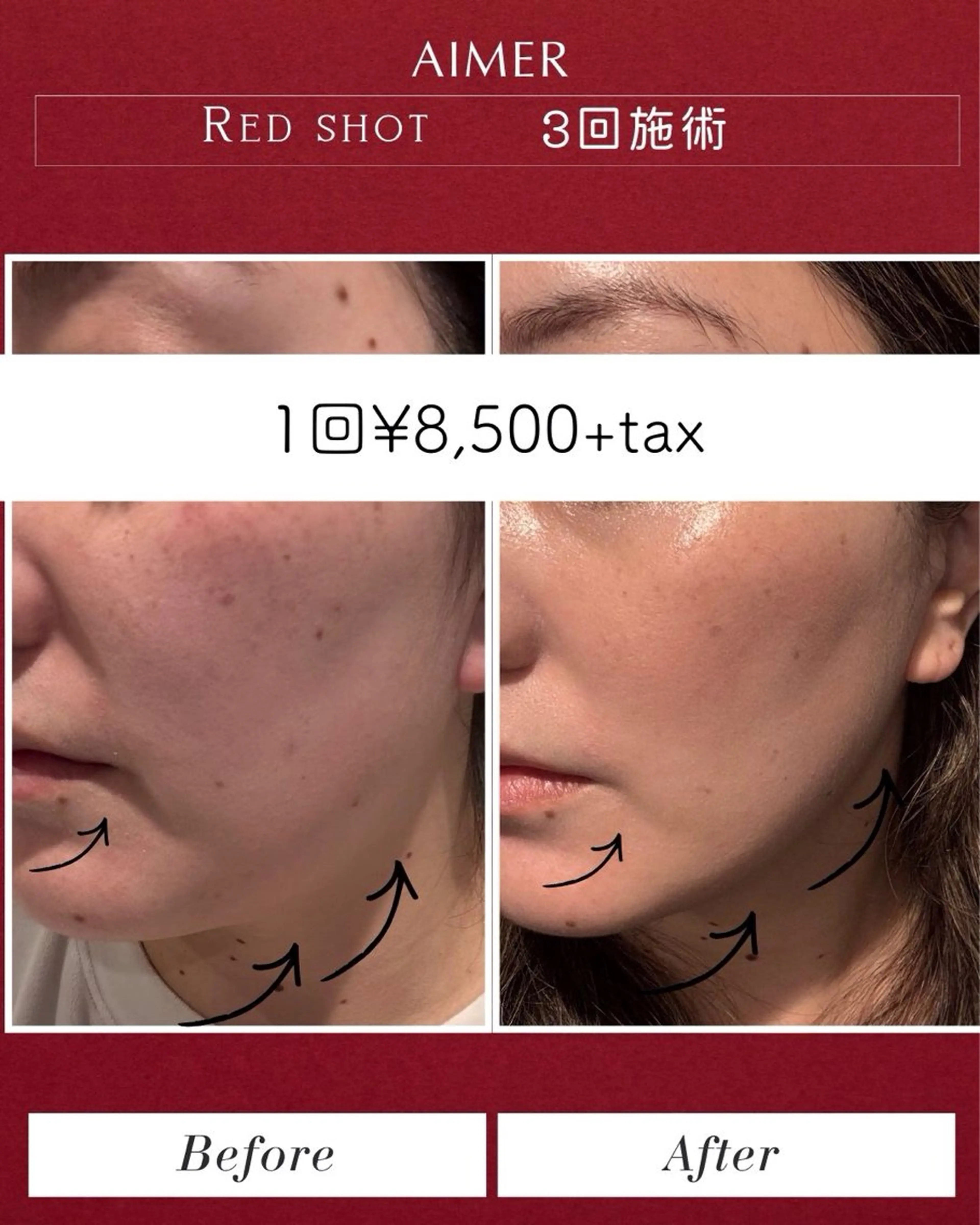 【韓国で話題のレッドショット!和歌山で施術できる!】の写真