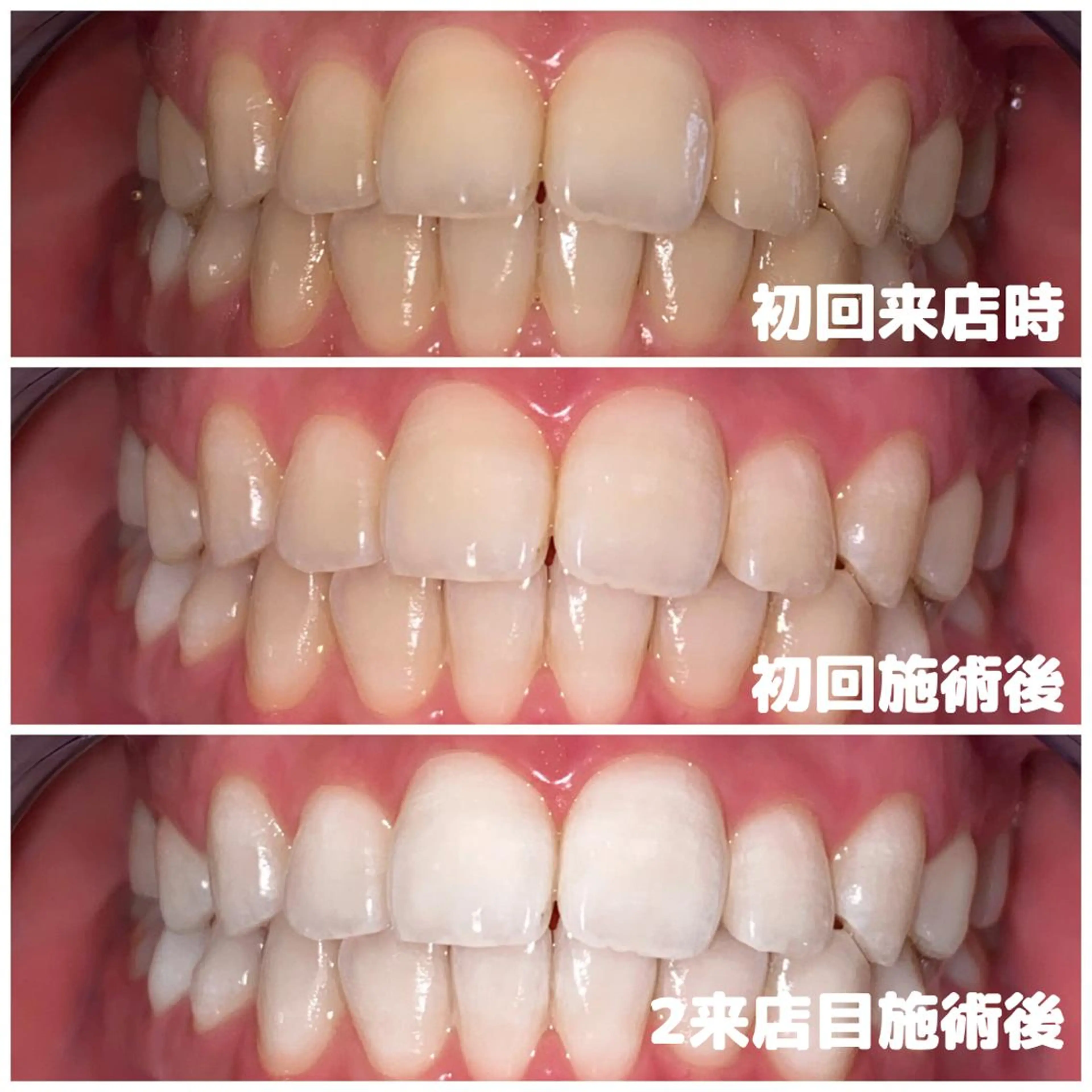 【 白さを極める・2来店で集中ケア 】🔹高濃度プレミアムホワイトニング〈 2来店合計70分照射 〉🔹の写真