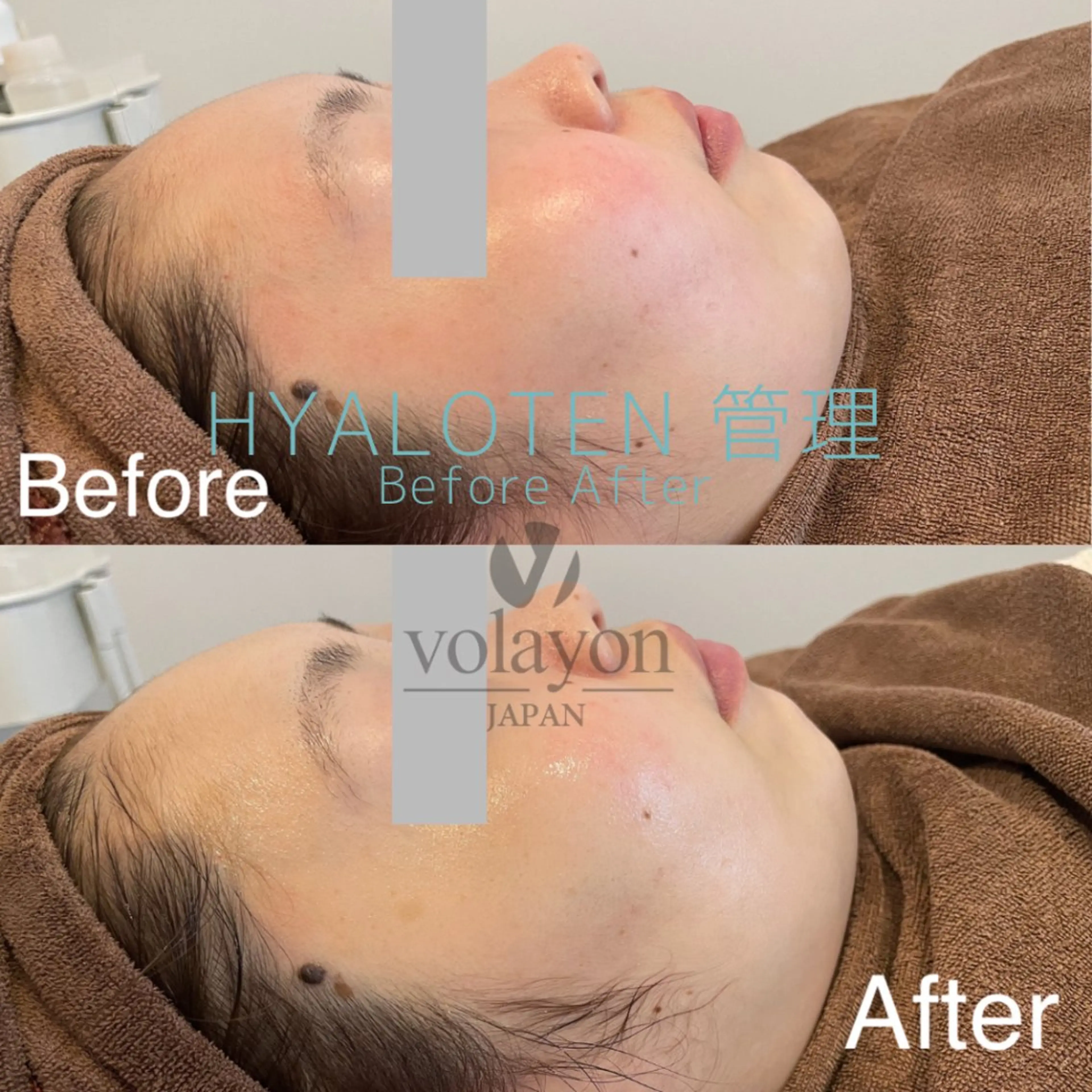 Hilluin大曽根 韓国肌管理のエステ・リラクイメージ