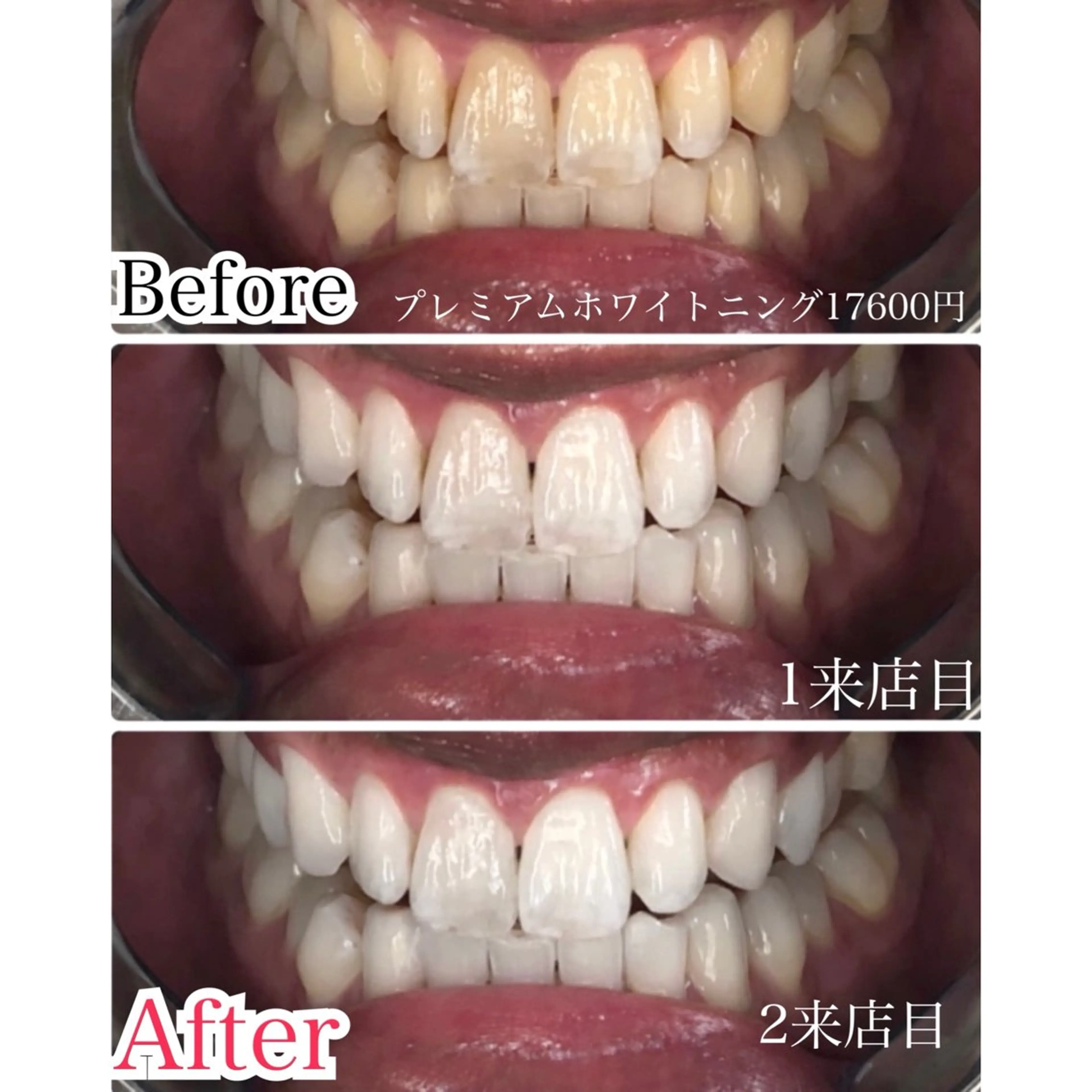 【最速】プレミアムホワイトニング💁♀️<合計80分照射2来店>の写真