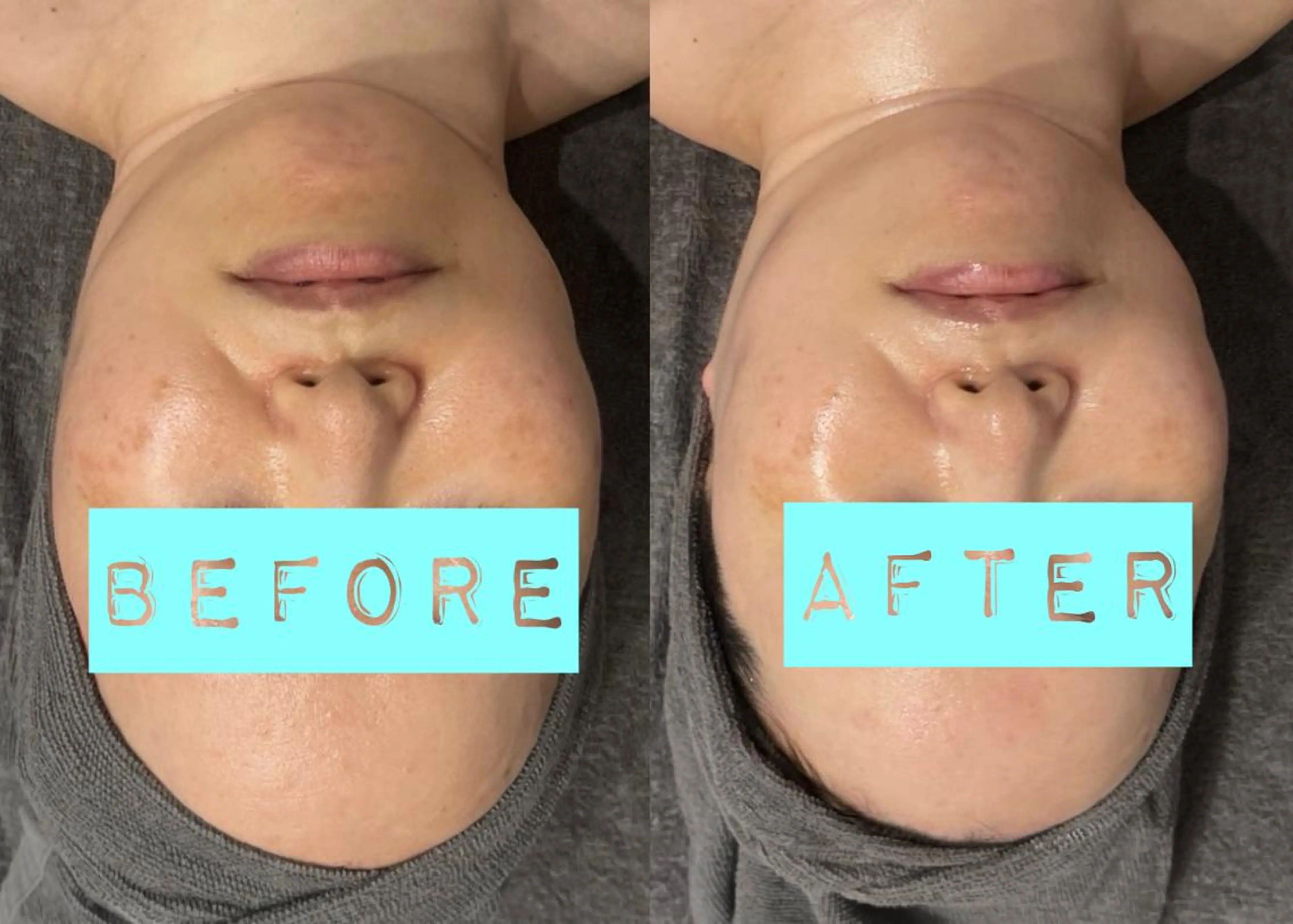 「肌を磨き上げ、育て上げる」　第５世代ピーリング【陶肌ピール】　首・肩・デコルテの15分マッサージ付き♪の写真