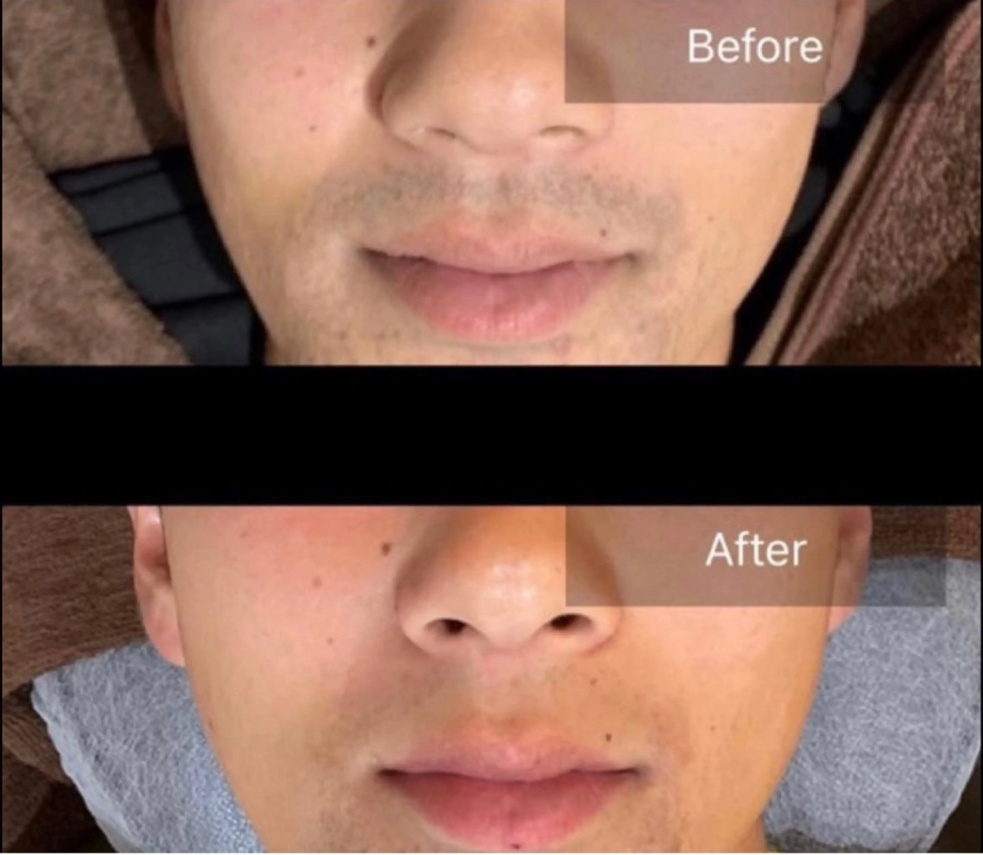 メンズ脱毛　〔ひげ1箇所〕Sパーツの写真