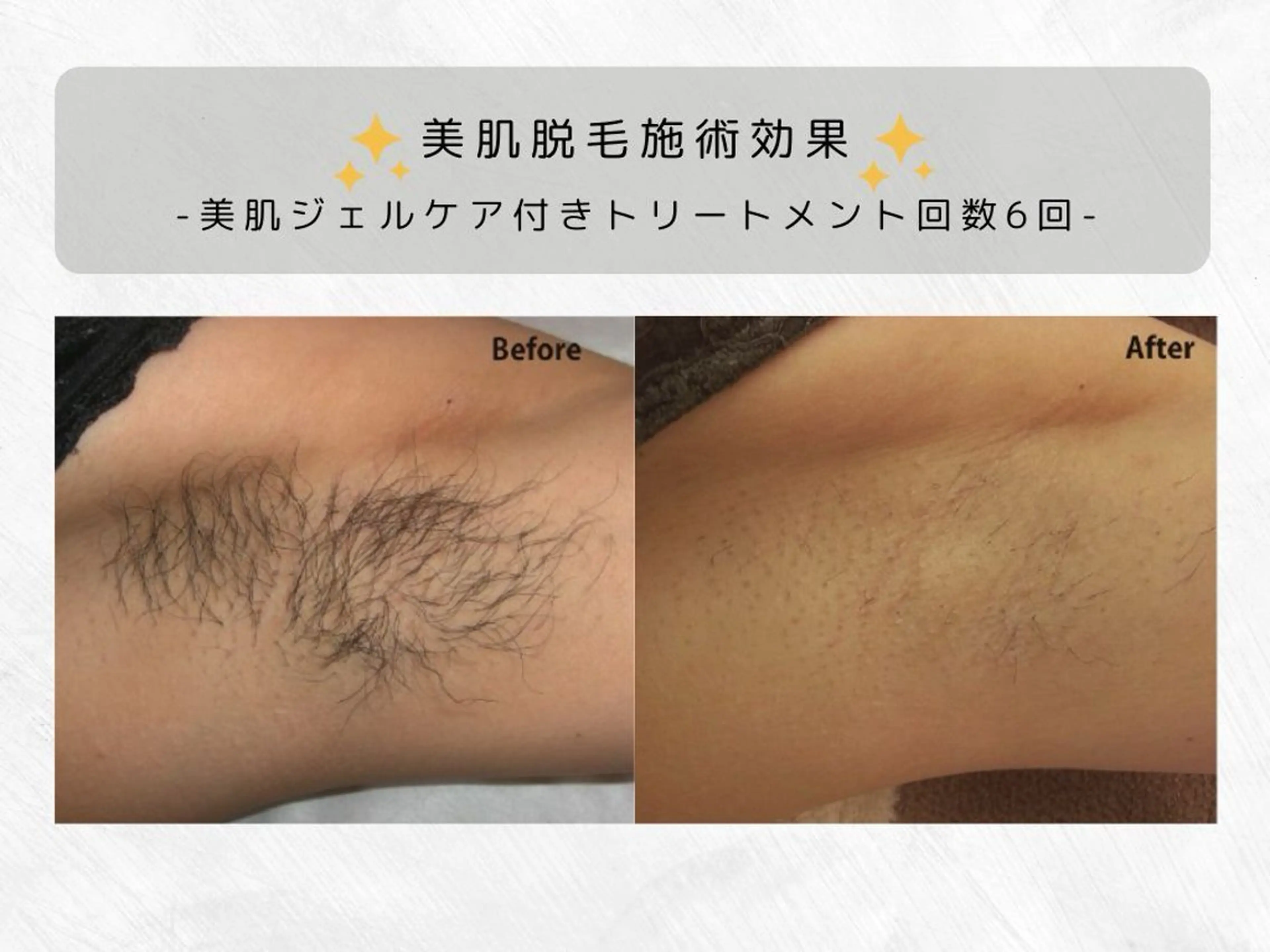 脱毛 VIKI BEAUTY  クレイハーブピーリング・美肌脱毛専門店所属・VIKI BEAUTYのエステ・リラクイメージ