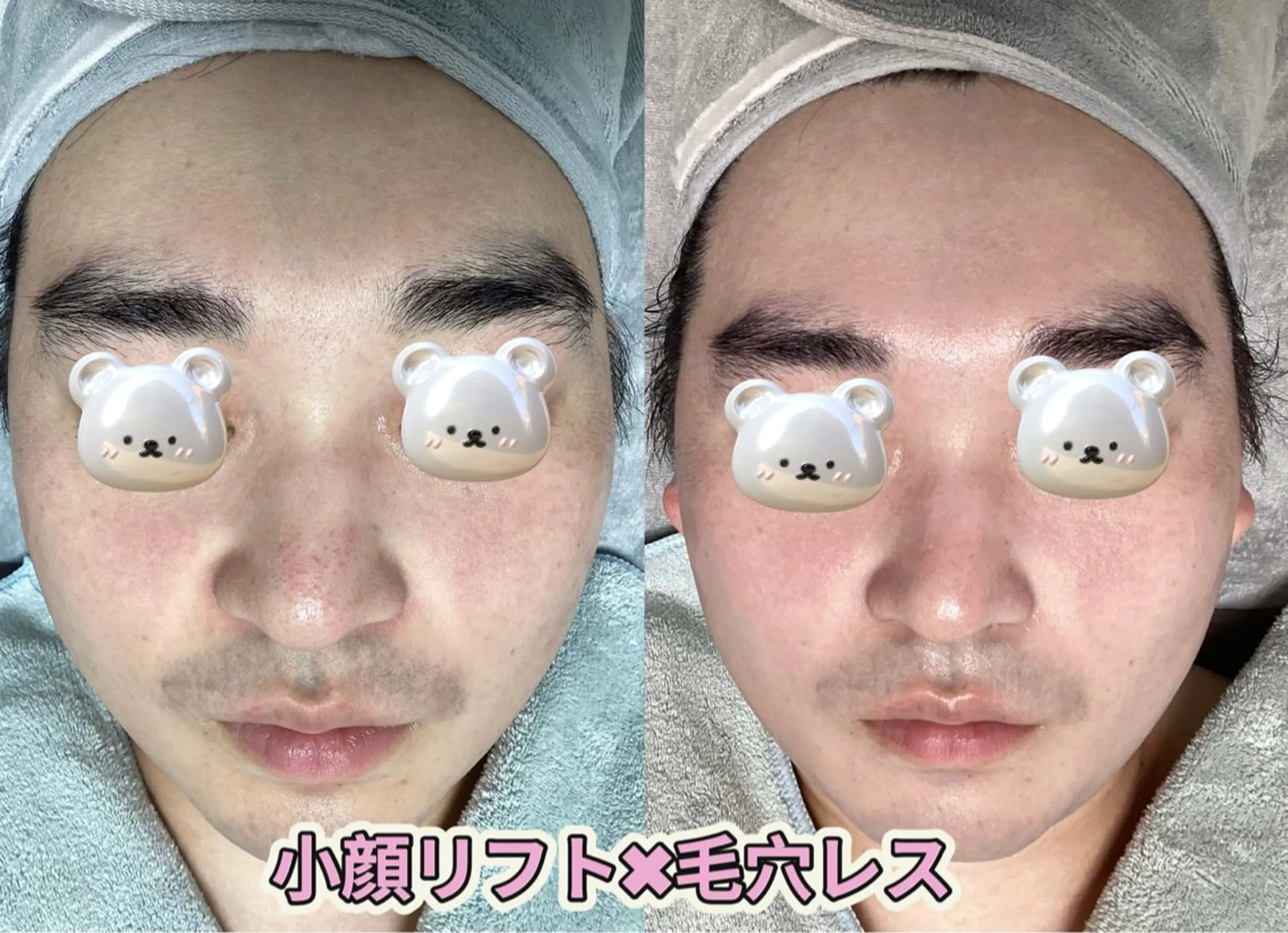 【毛穴レスと小顔同時に実現】毛穴ディープ洗浄×小顔リフトリンパマッサージ、メンズもおすすめの写真