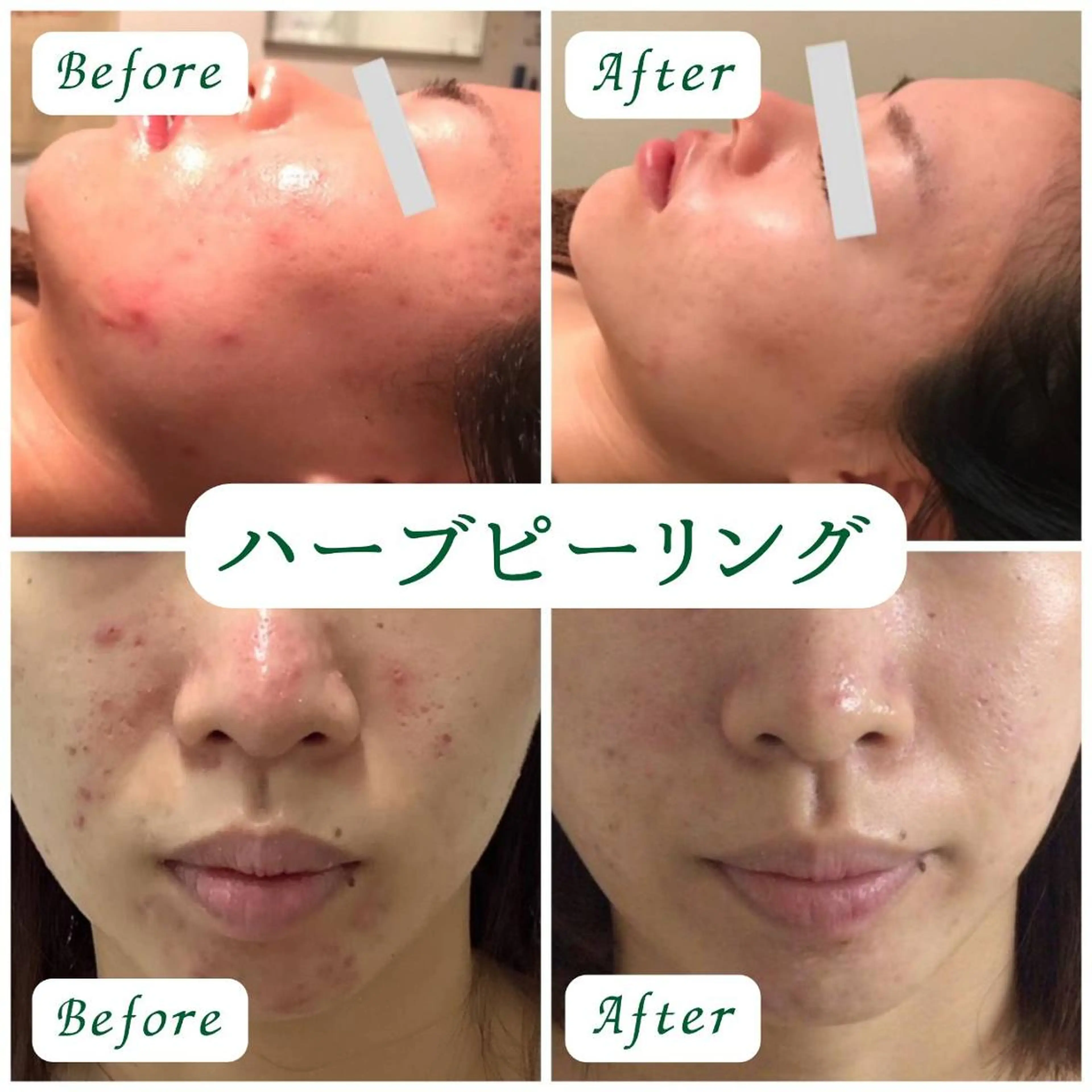 エステ 美容鍼・整体サロン アネモネ🌸心斎橋のエステ・リラクイメージ