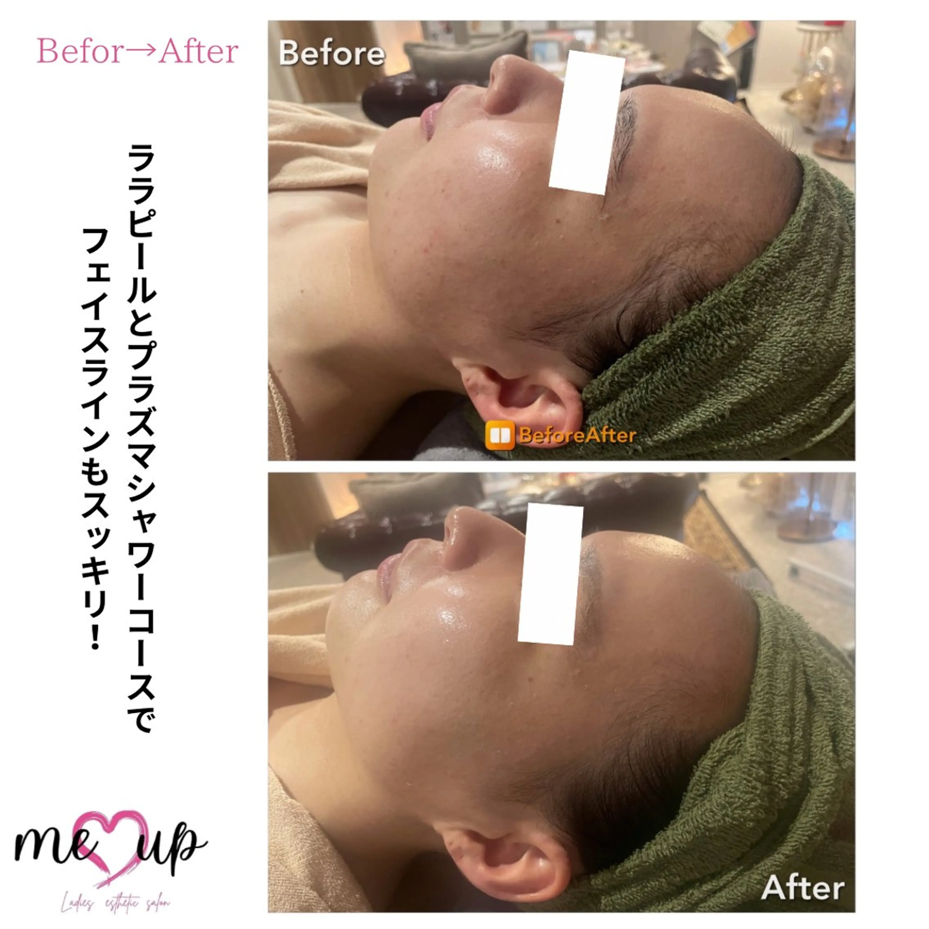 エステ Meupニキビ専門店 背中/ハーブ/肌管理のその他イメージ