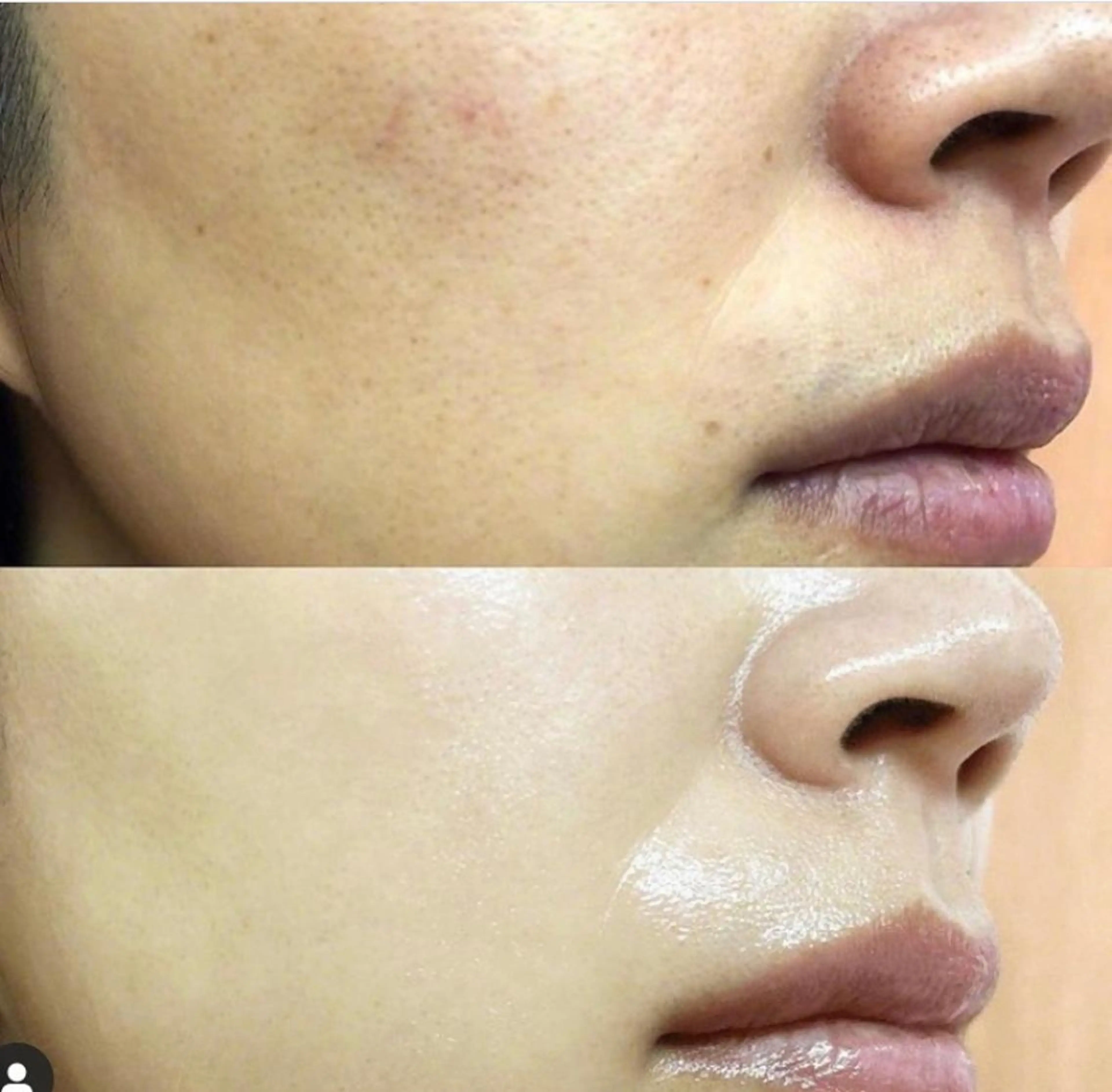 セルフ♡光フェイシャルの写真