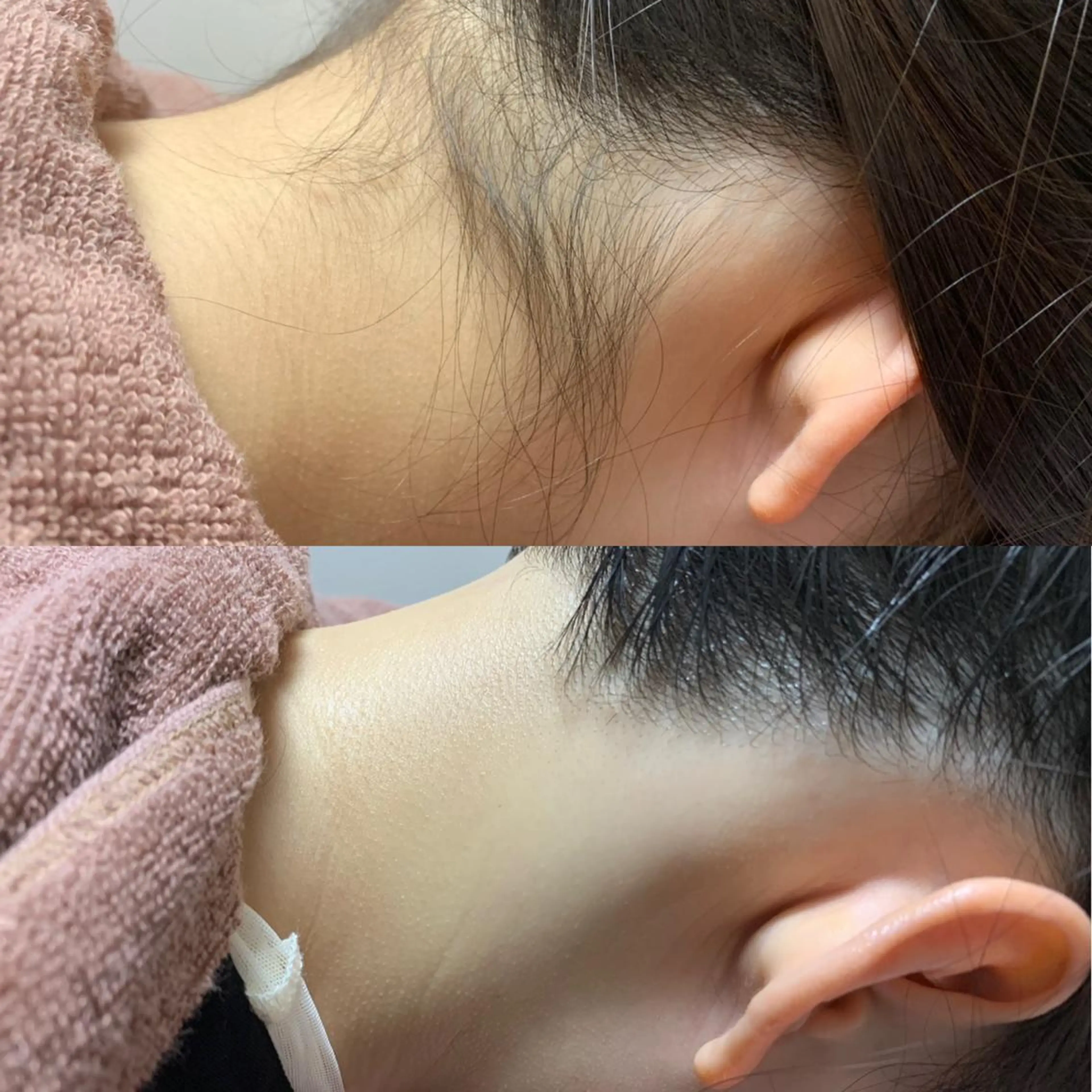 【うなじ美人に💎】うなじ脱毛＋保湿付♡形相談もOKで後ろ姿に自信✨の写真