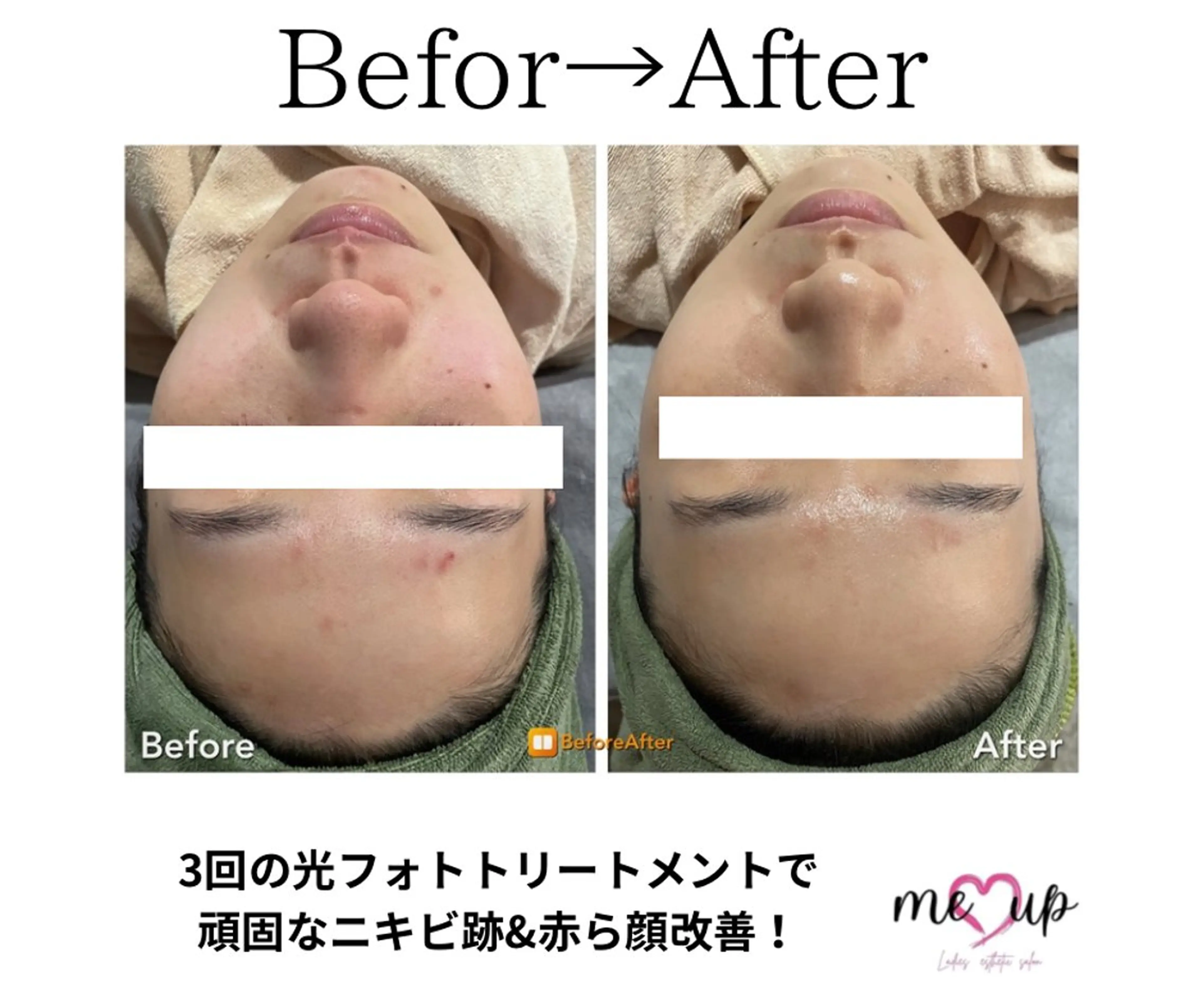 Meupニキビ専門店 背中/ハーブ/肌管理のその他イメージ