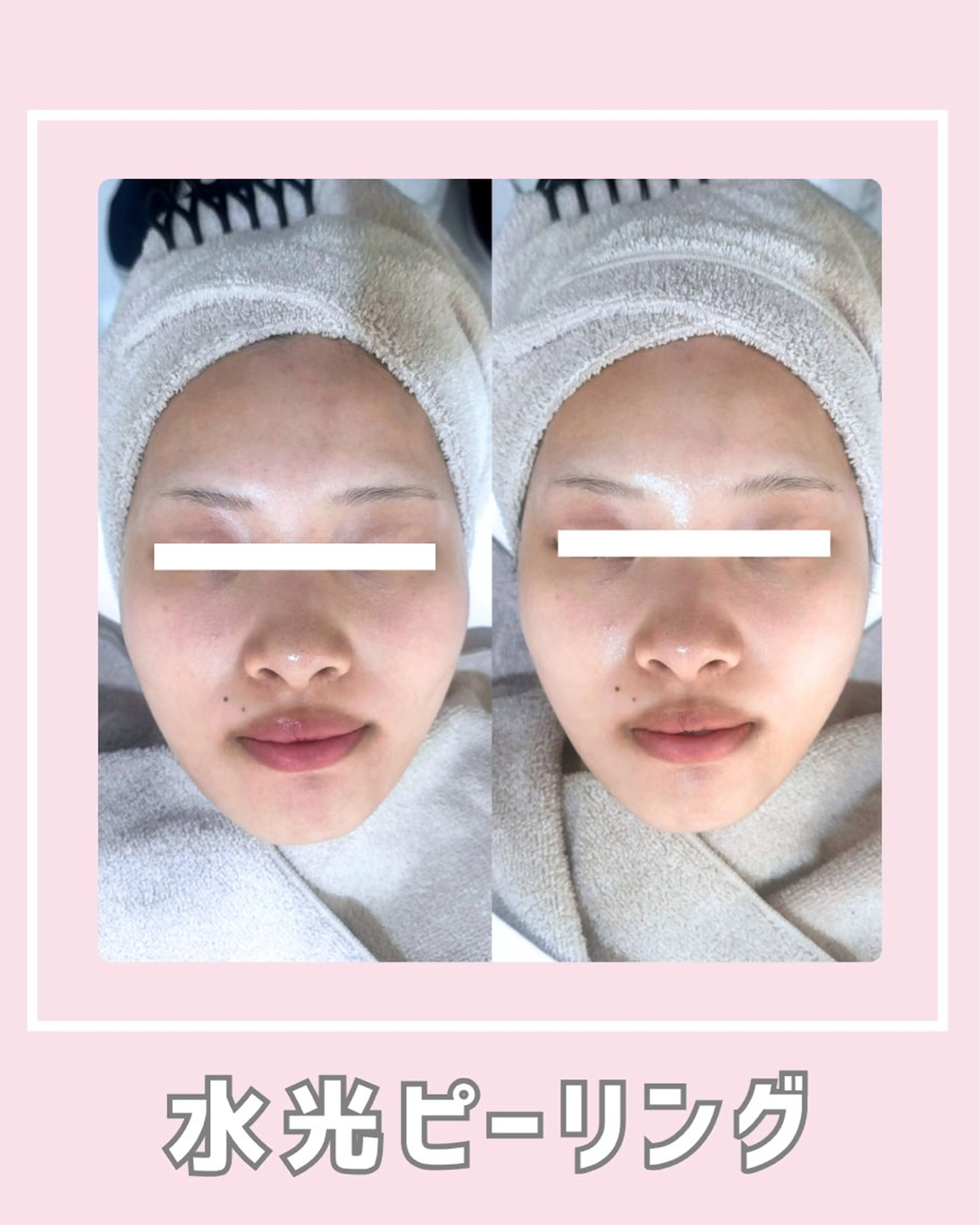 |ピーリング・毛穴| soina神楽坂のエステ・リラクイメージ