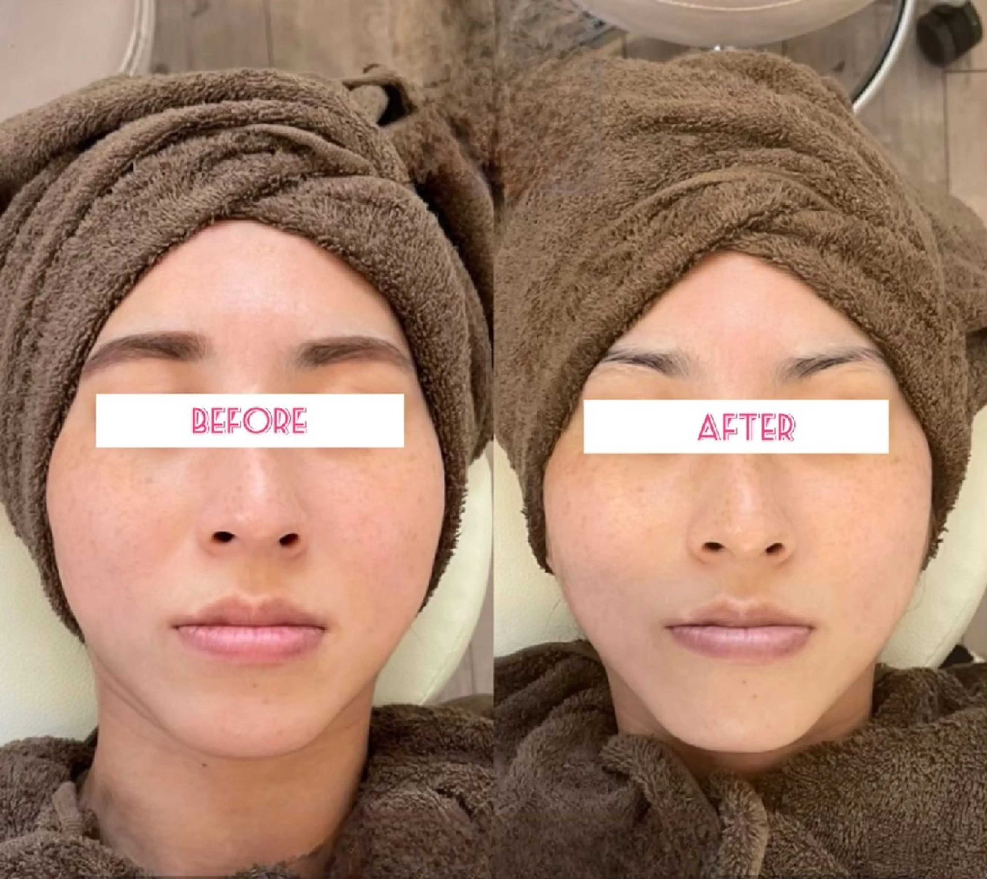 【✨1日1名様限定✨】エラ張りが気になる方へエラ改善コースの写真