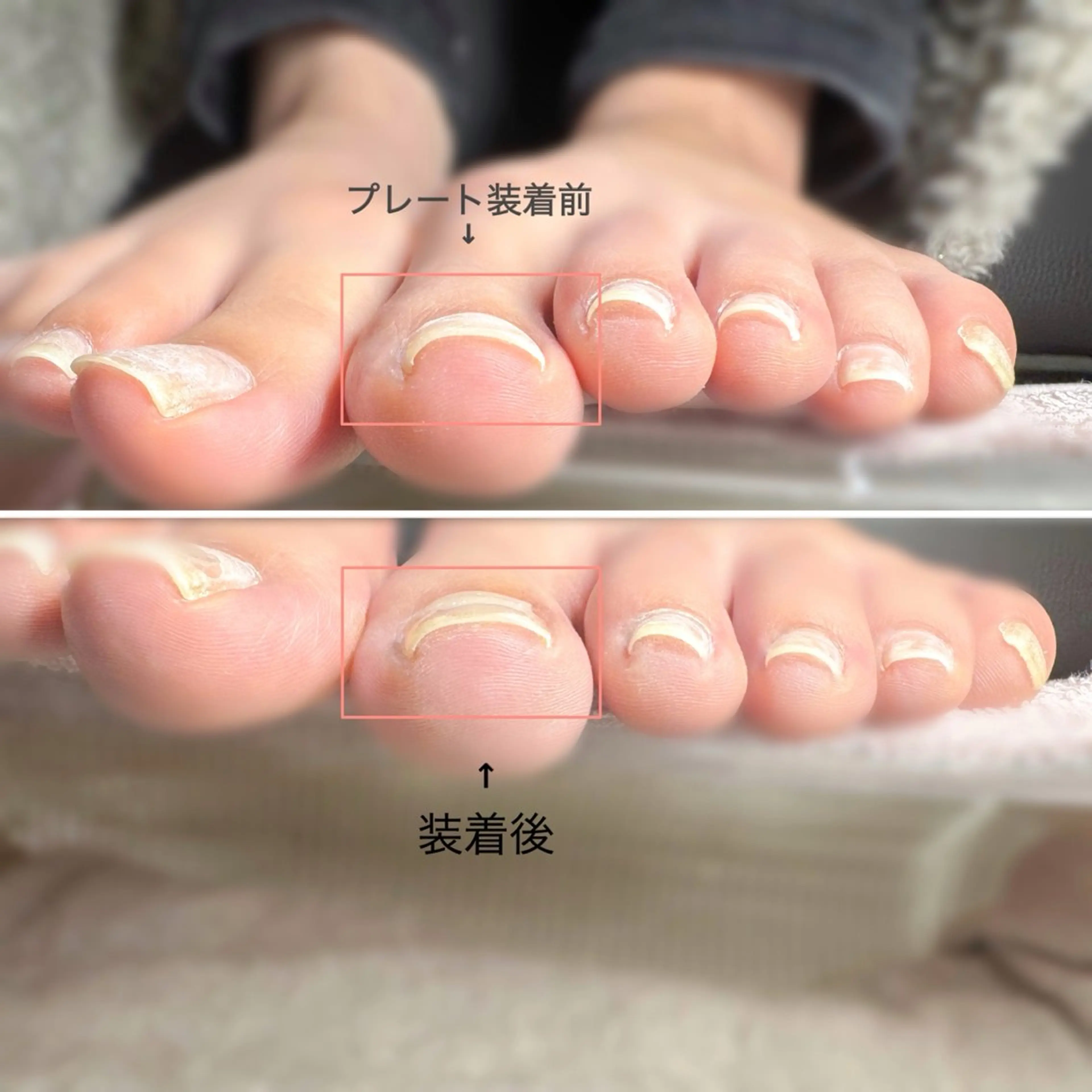 巻き爪矯正(一趾) ドライケア込の写真