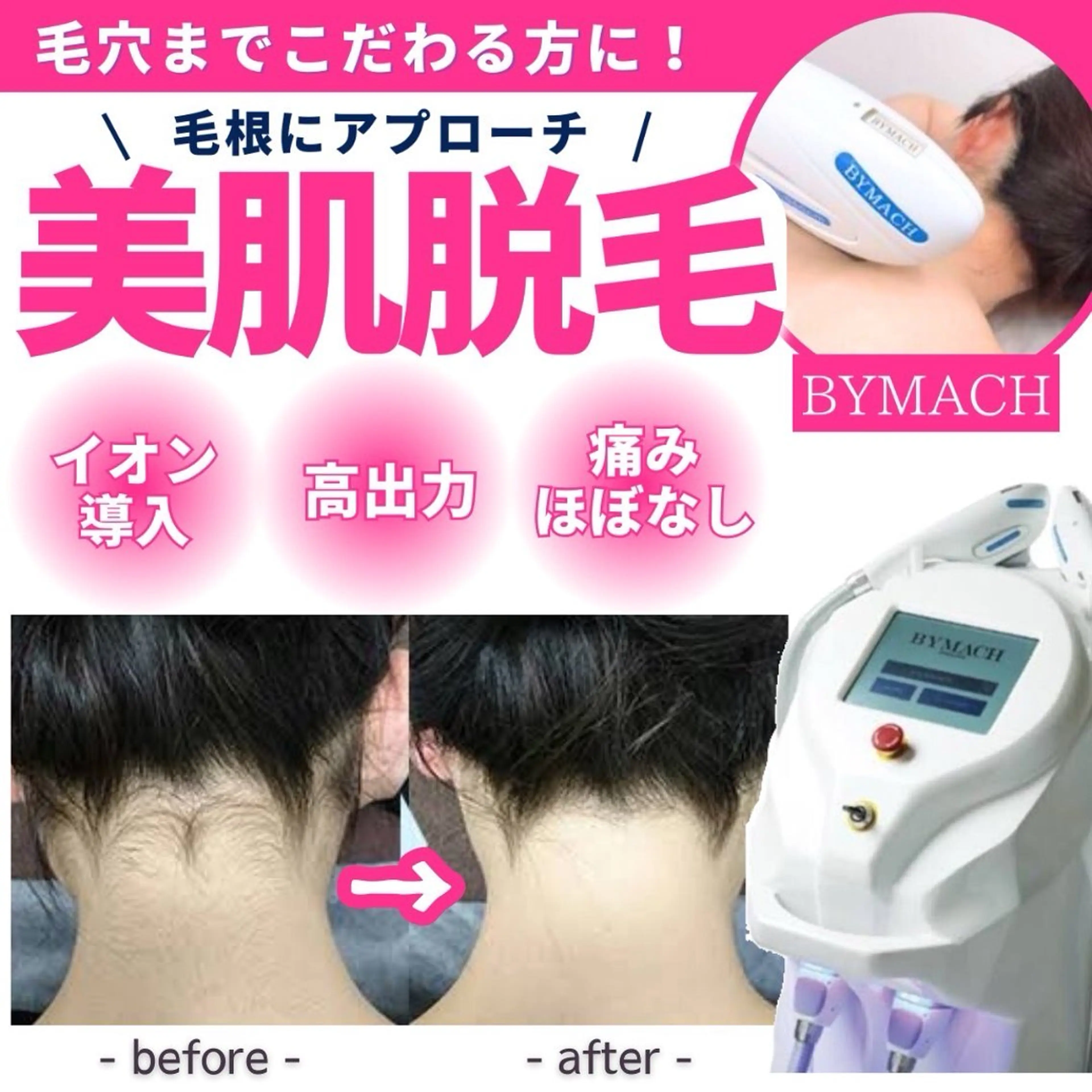 【過去最安値🉐】顔脱毛 ¥6,980 → ¥1,500の写真