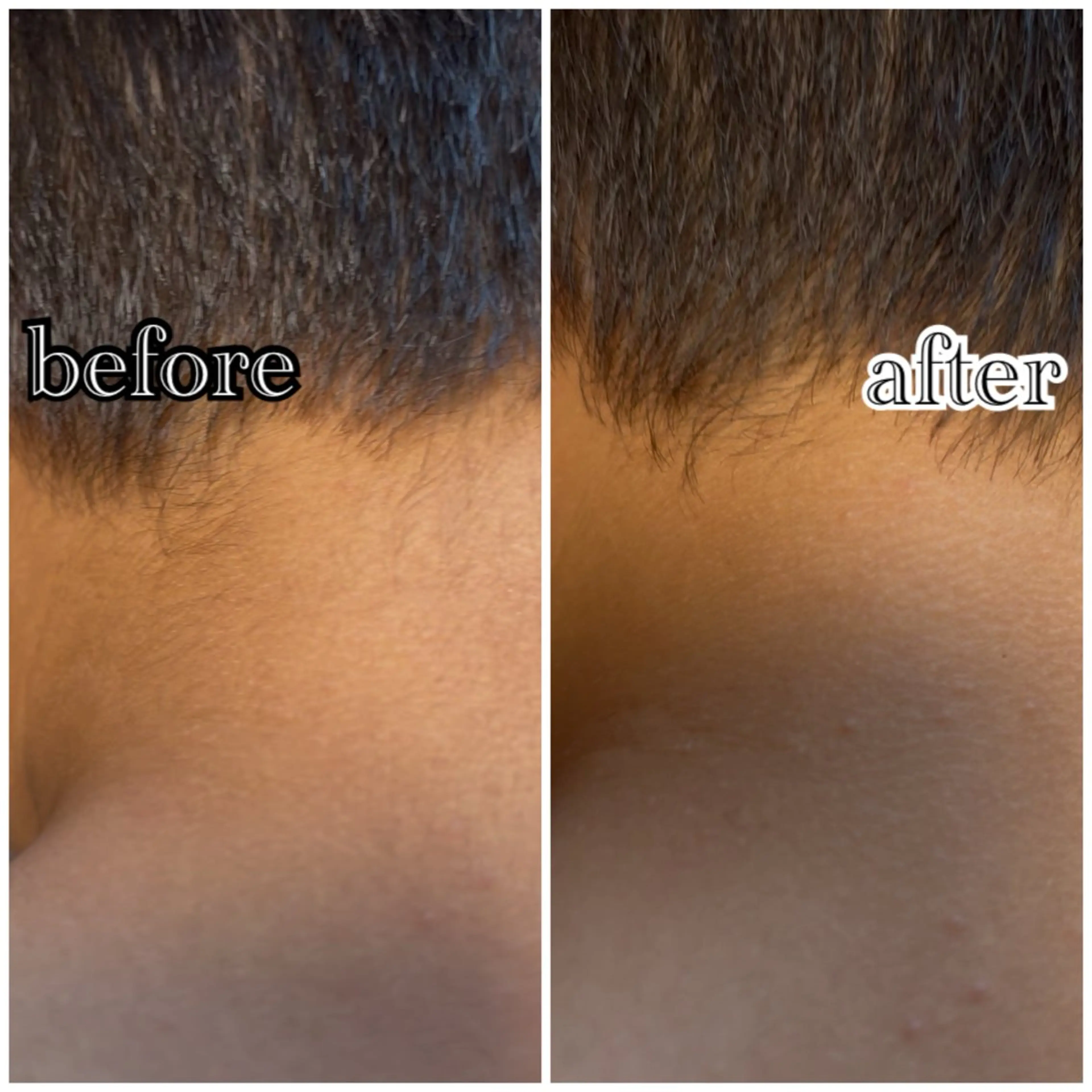 キッズ脱毛✨脱毛箇所お選び頂けます🌻の写真