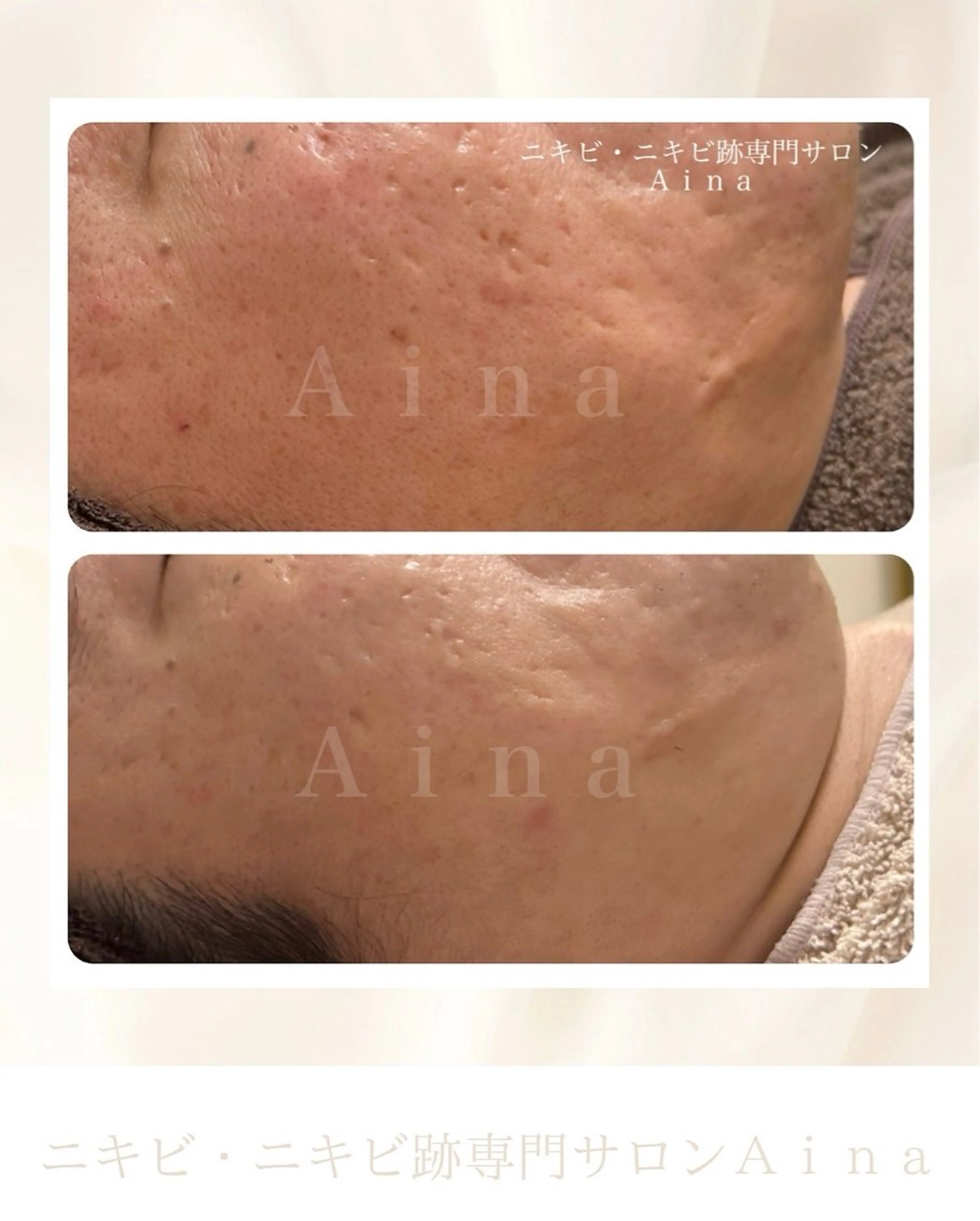 エステ リラク ニキビ跡専門サロン Ａｉｎａのエステ・リラクイメージ