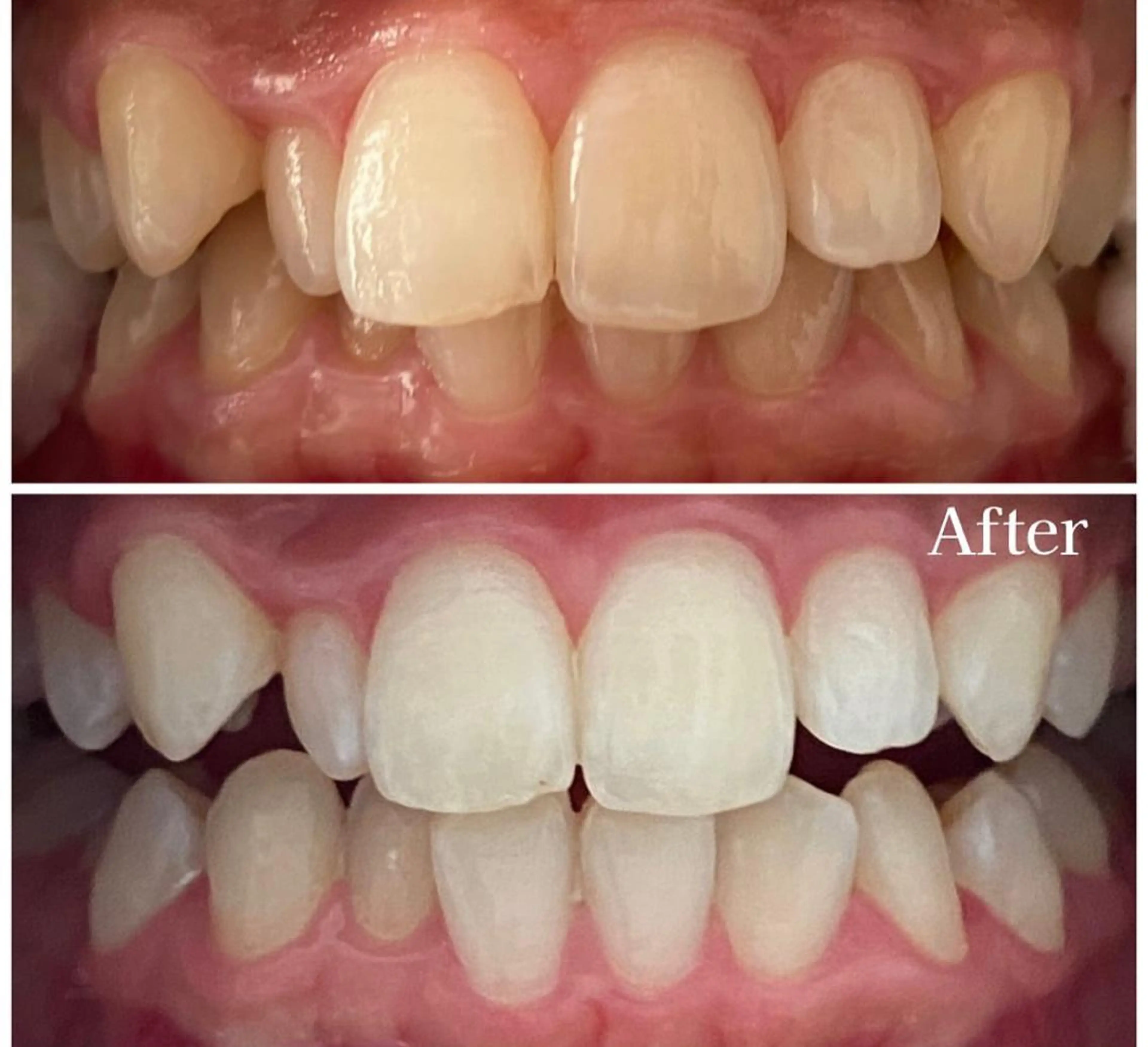 🦷歯のセルフホワイトニング🦷　14分× 3回の写真