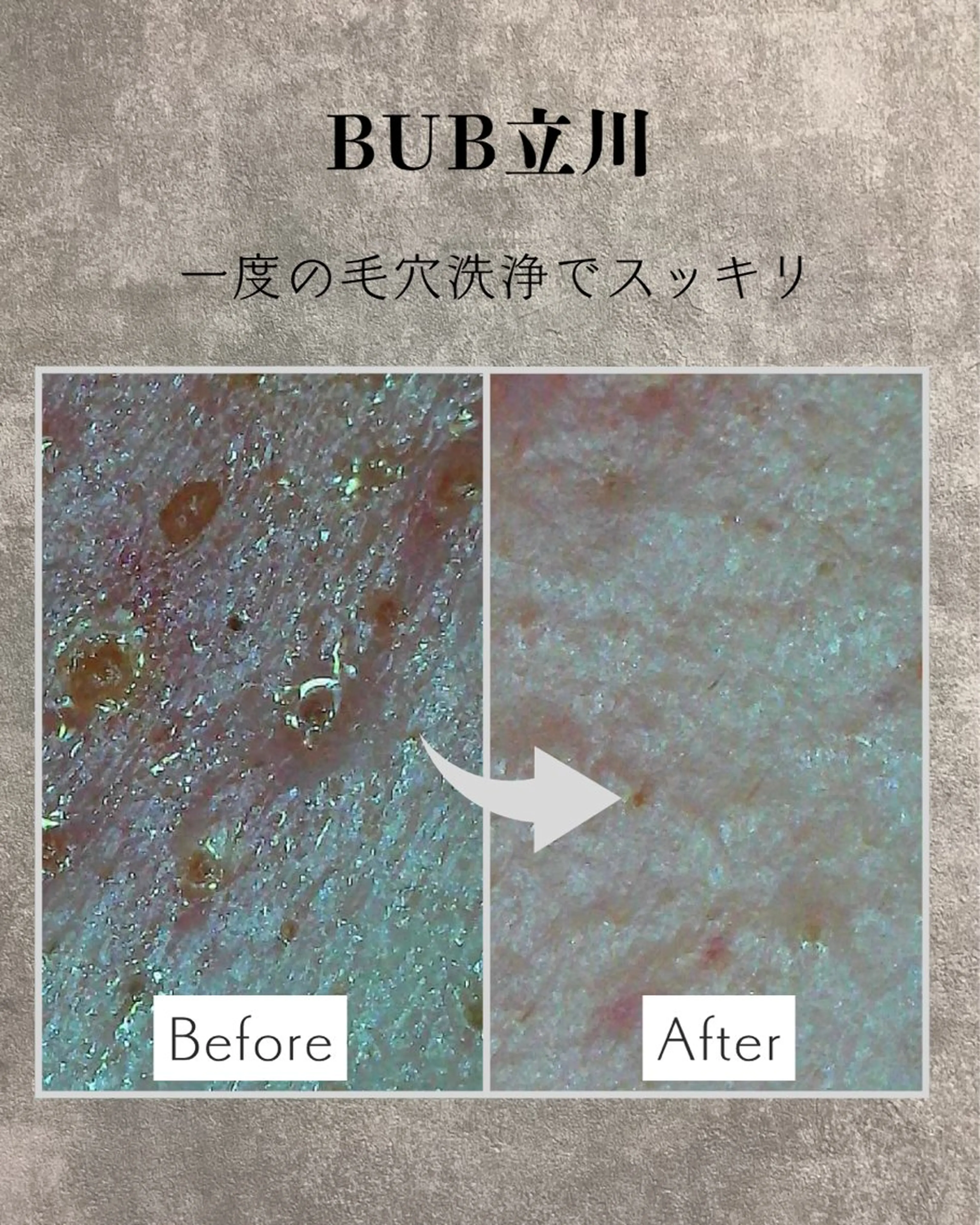 【メンズ毛穴汚れを根こそぎ】ハイドラ毛穴洗浄No.1人気｜黒ずみ・角栓・皮脂を一気にオフ🥇の写真