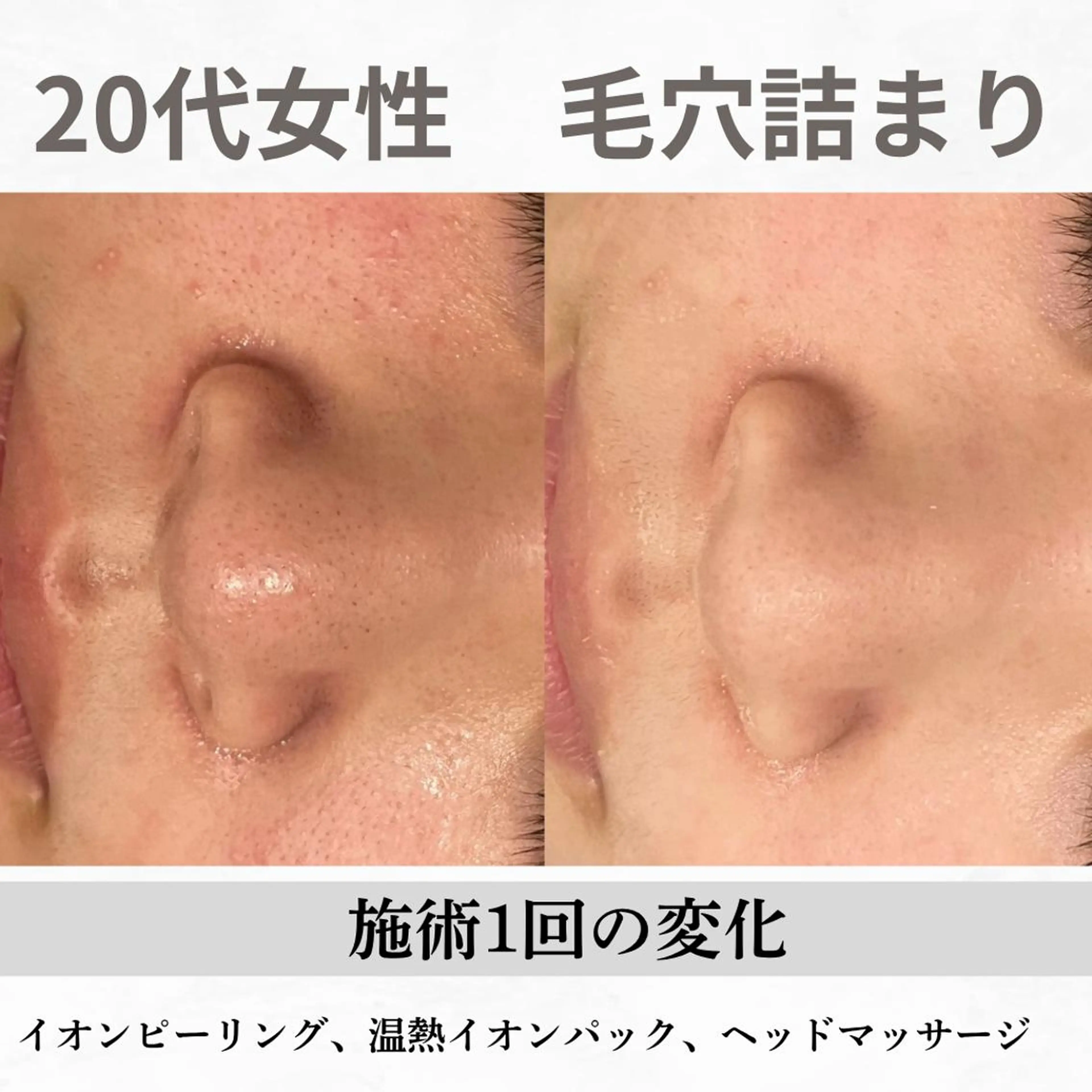 重度ニキビ専門🌷 ダウンタイムなしのエステ・リラクイメージ