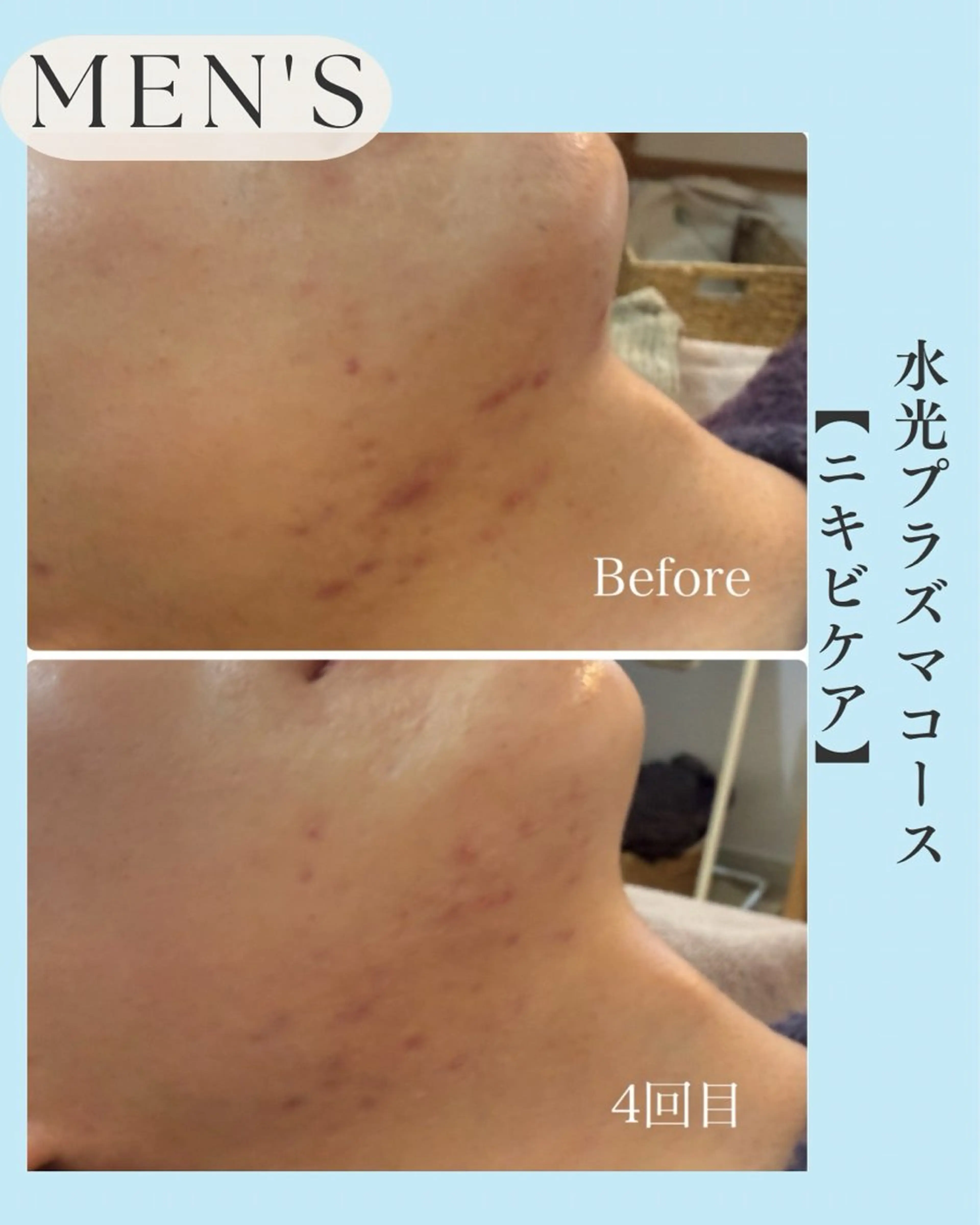 メンズ エステ 小顔＆肌質改善 NICORIのエステ・リラクイメージ