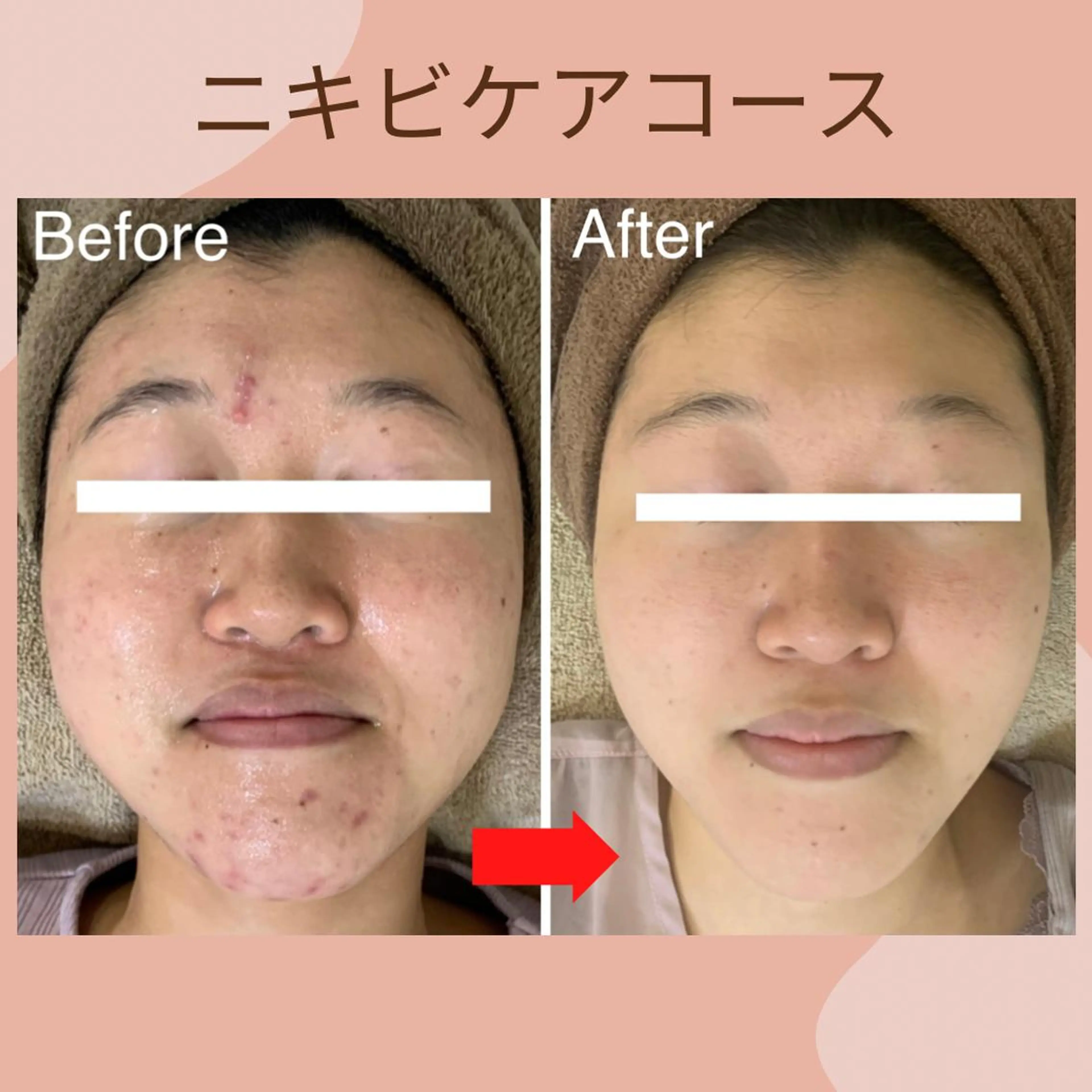 【大人ニキビケアコース】毛穴洗浄・パック・マッサージ（ニキビ・皮脂過剰分泌😷マスクニキビにもおすすめ😷）の写真