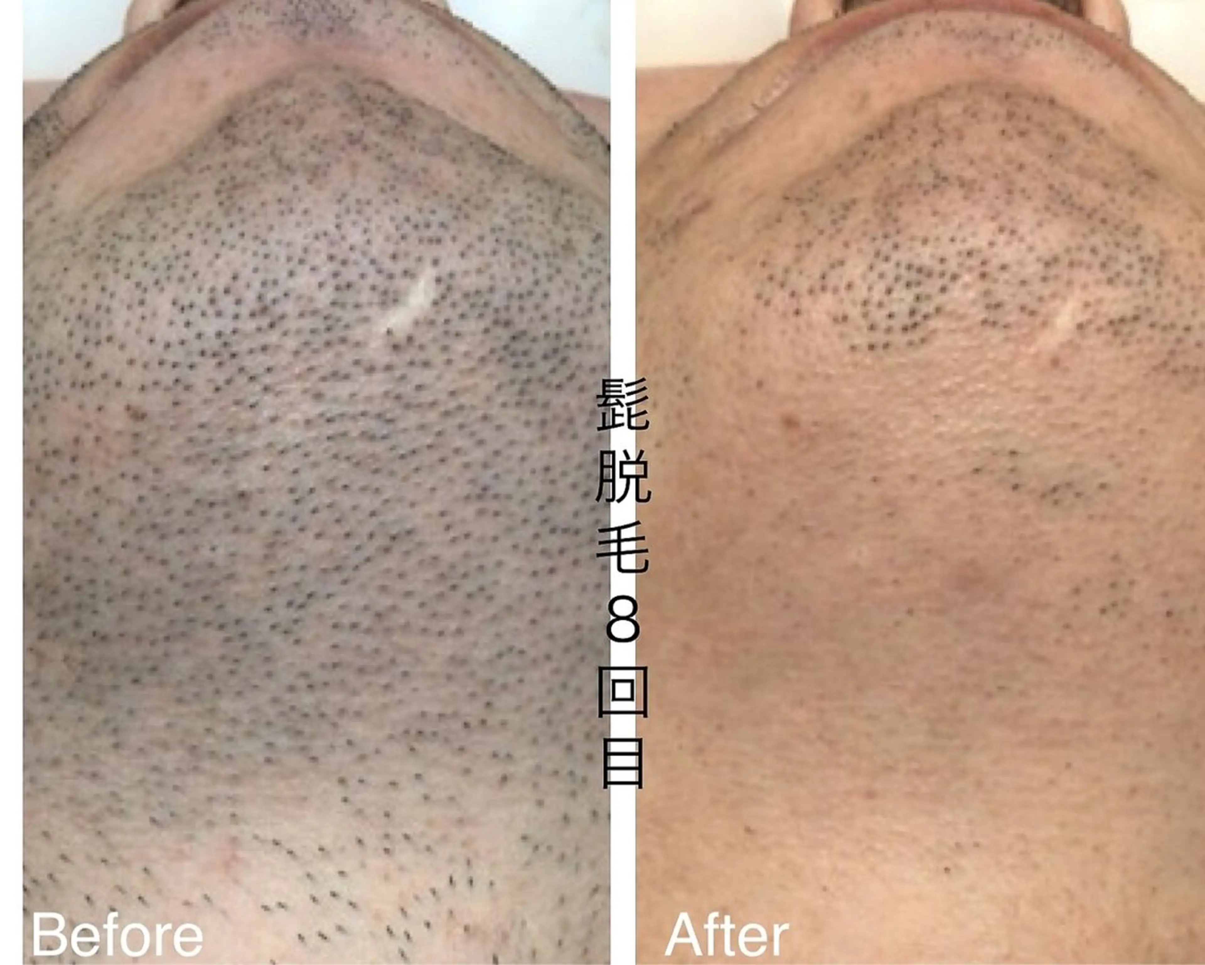 メンズ キッズ 肌管理脱毛ピーリング CDFAkasakaのエステ・リラクイメージ