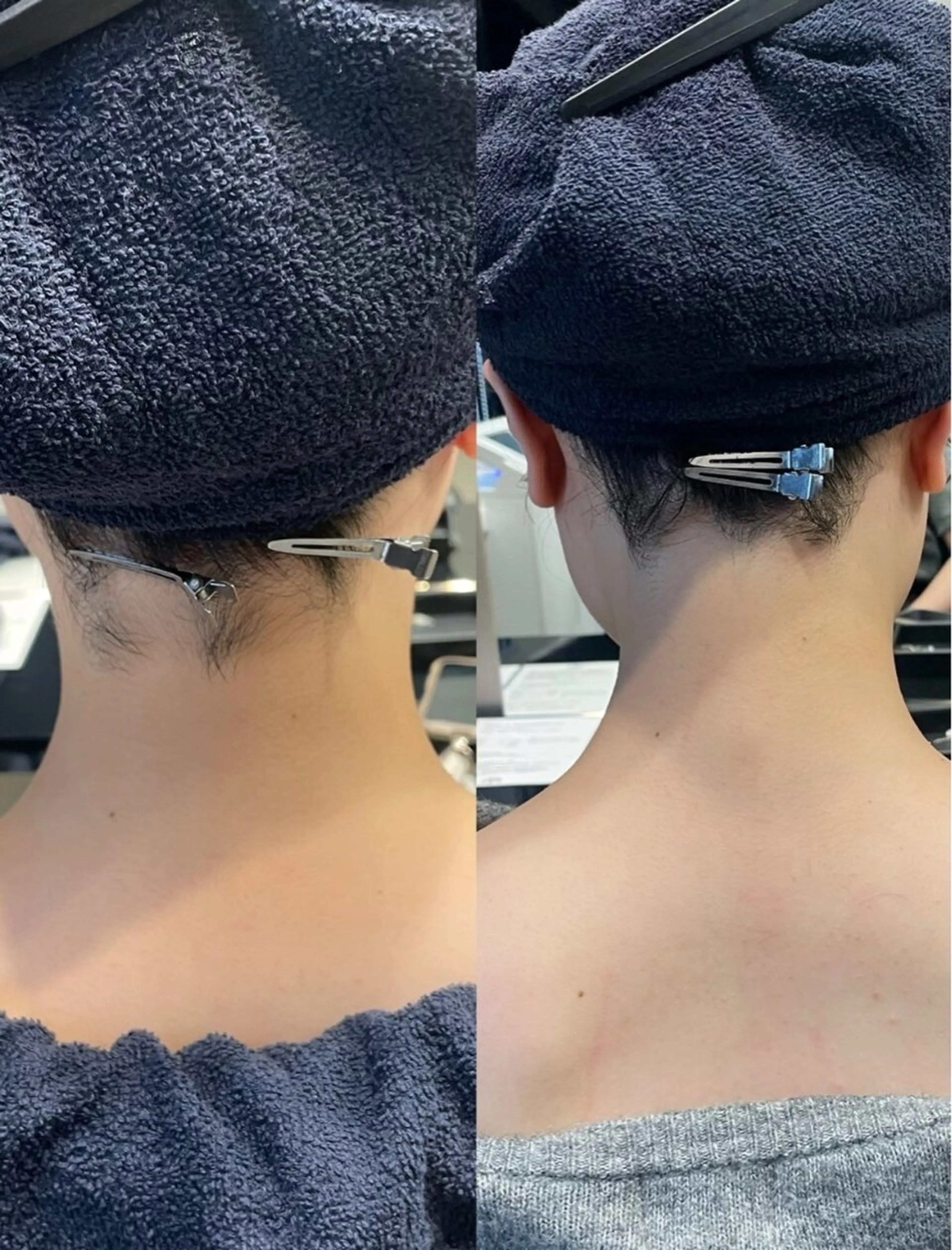 【ネープケア】 美容室でできるうなじ脱毛➕初回特別カウンセリング シェービング&シャンプーブロー込🫧の写真