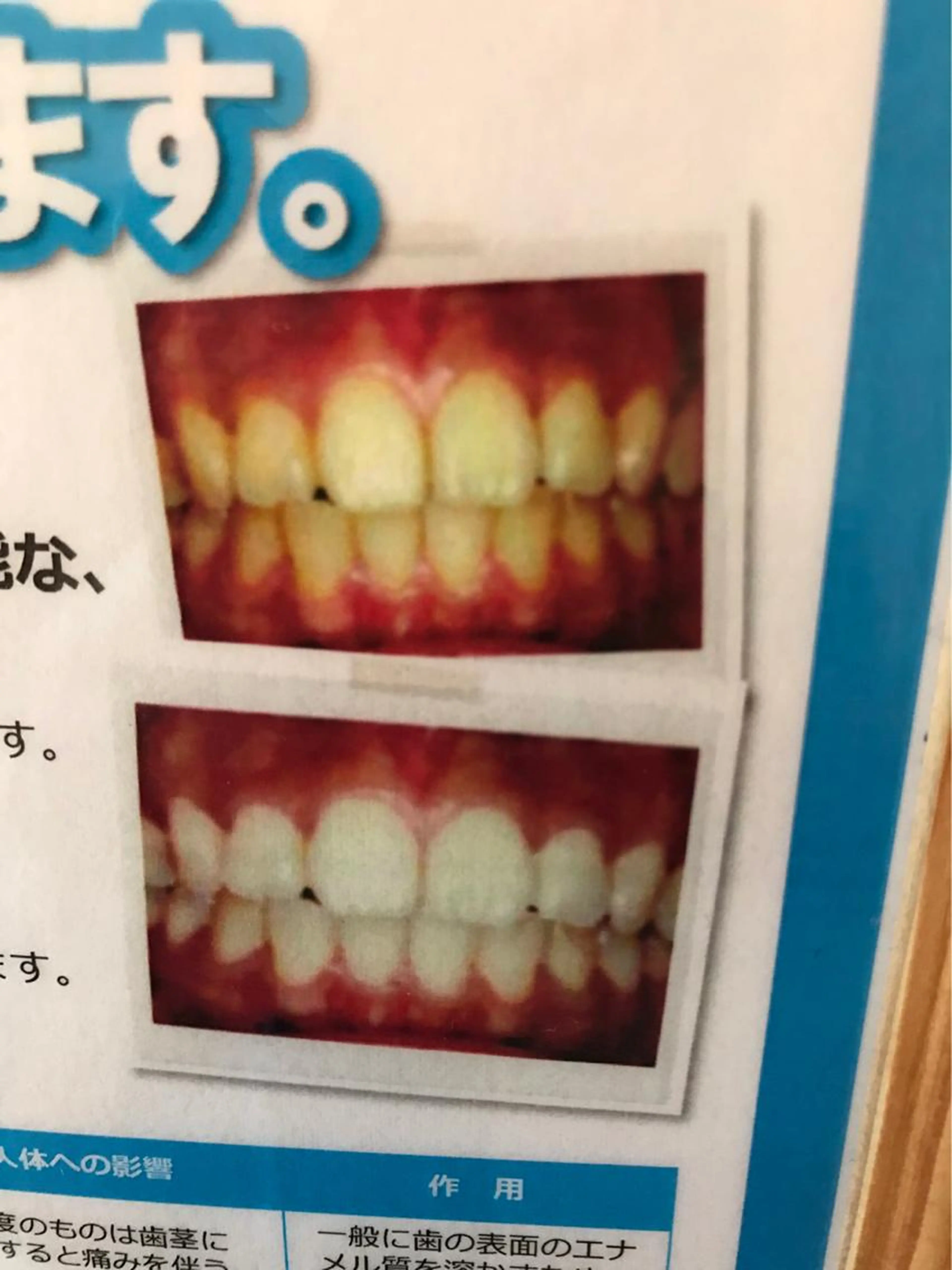 セルフホワトニングの写真
