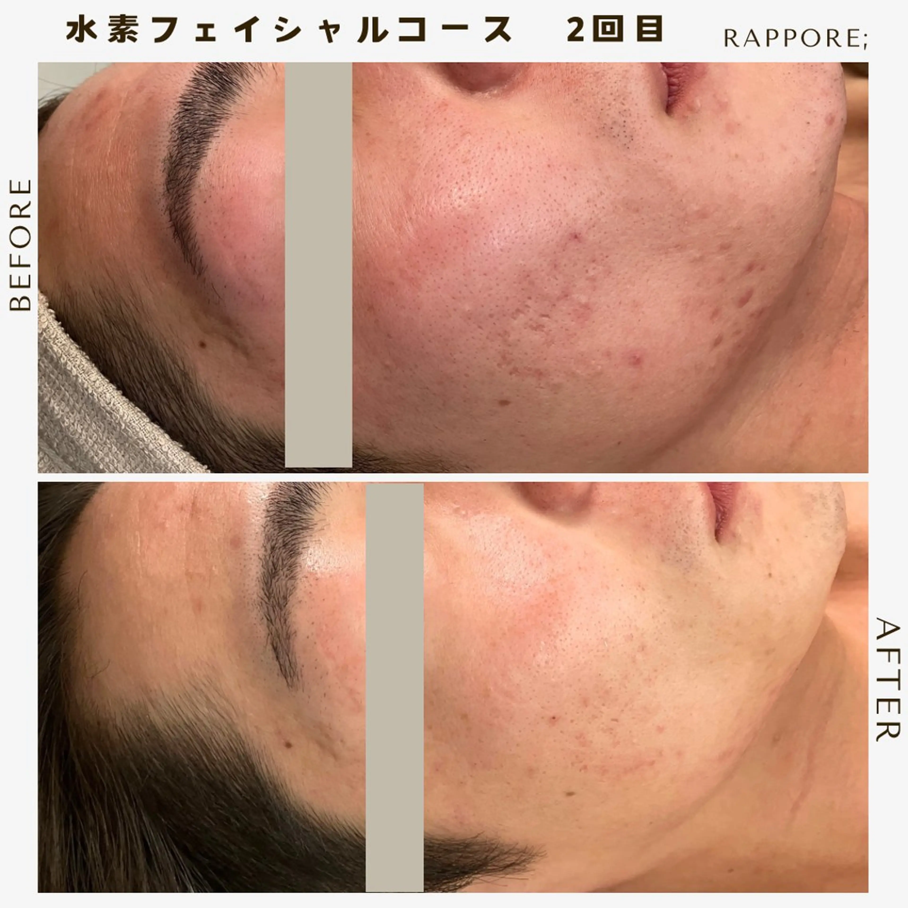 メンズ 脱毛 Rappore; 心斎橋　みずきのエステ・リラクイメージ