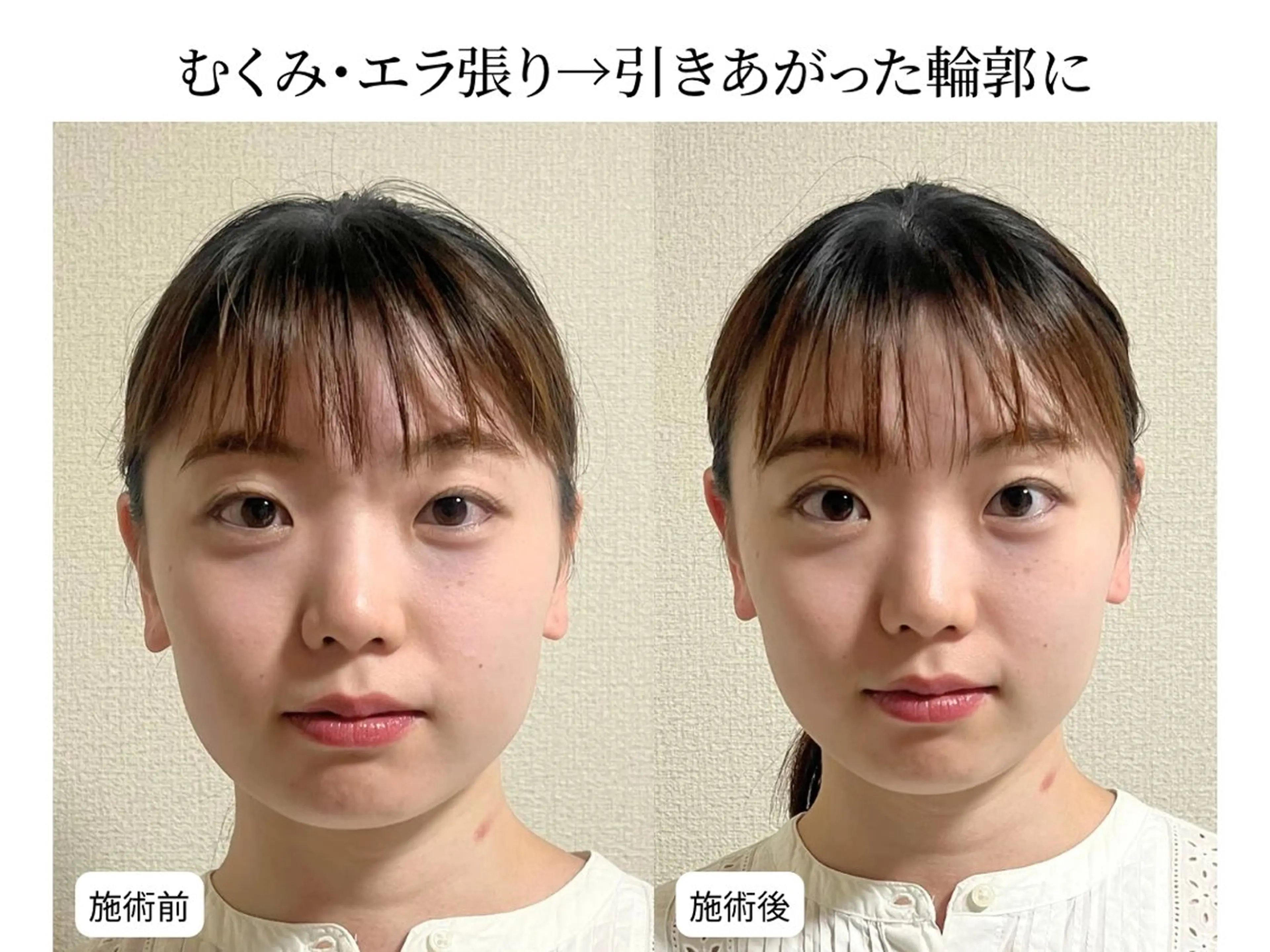 【横顔までキレイな印象美人】小顔整体＋4D小顔矯正＋姿勢矯正　12000円→の写真