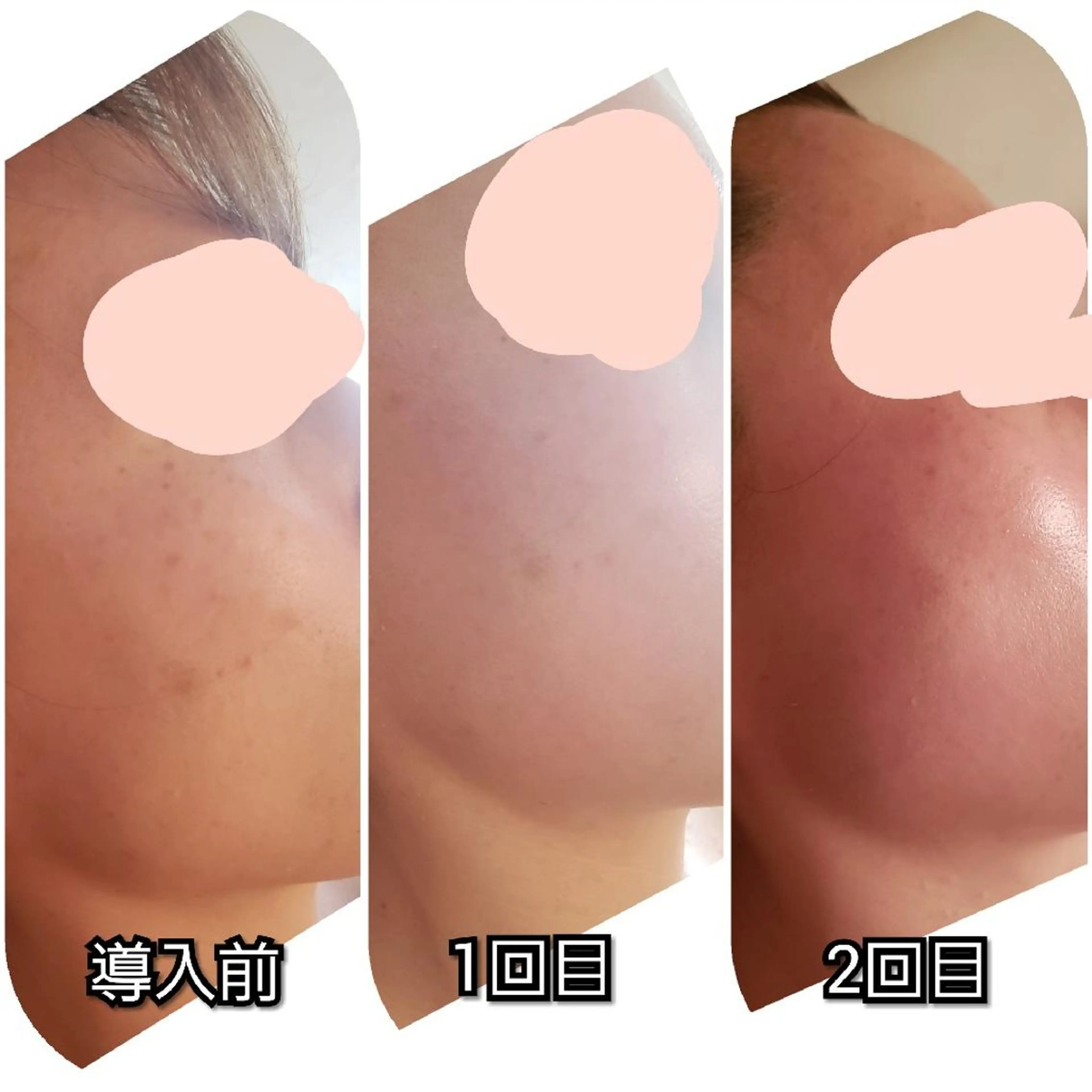 たるみ・ くすみ シミ・ニキビ肌改善のエステ・リラクイメージ