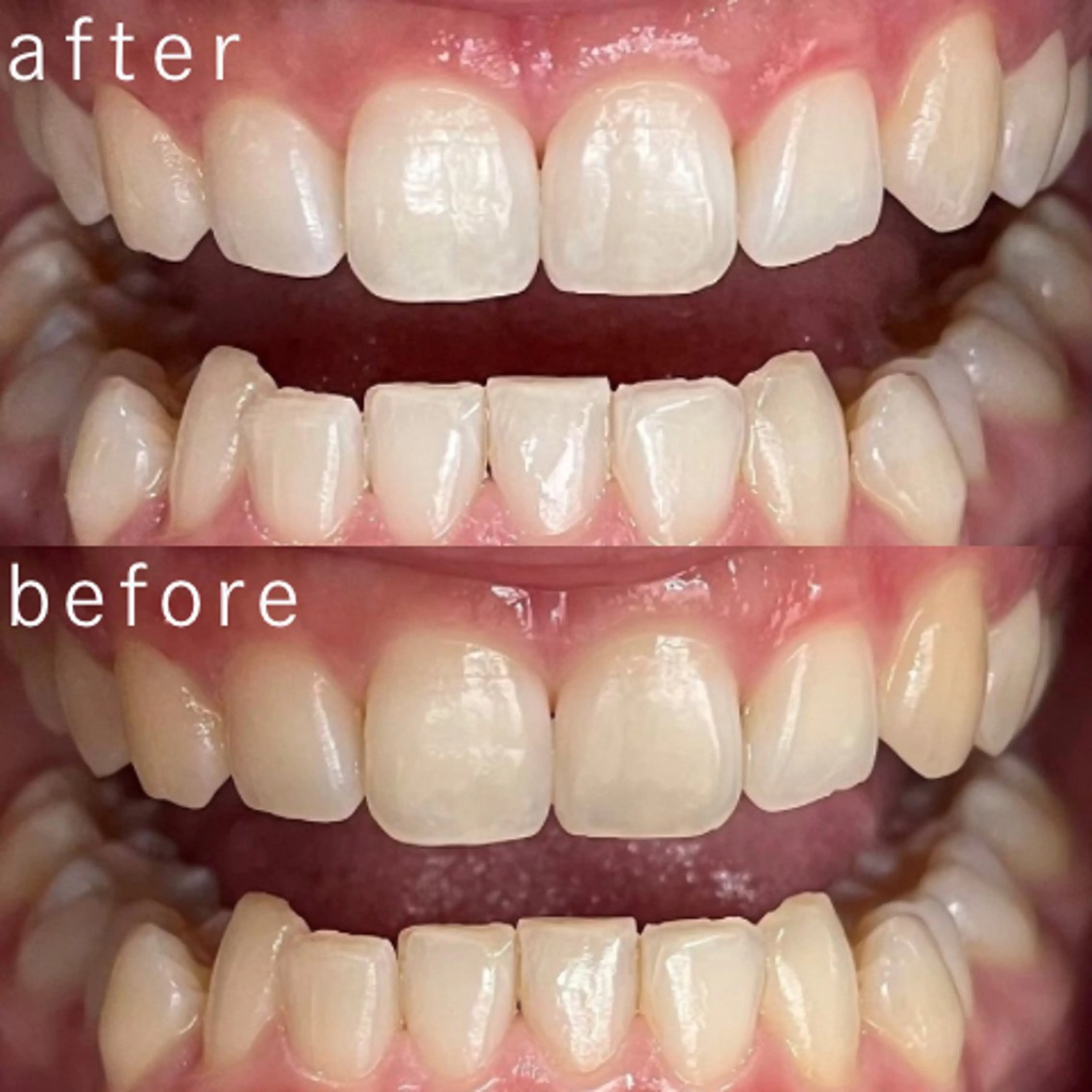 その他 セルフホワイトニング 都立大学🦷✴︎のその他イメージ