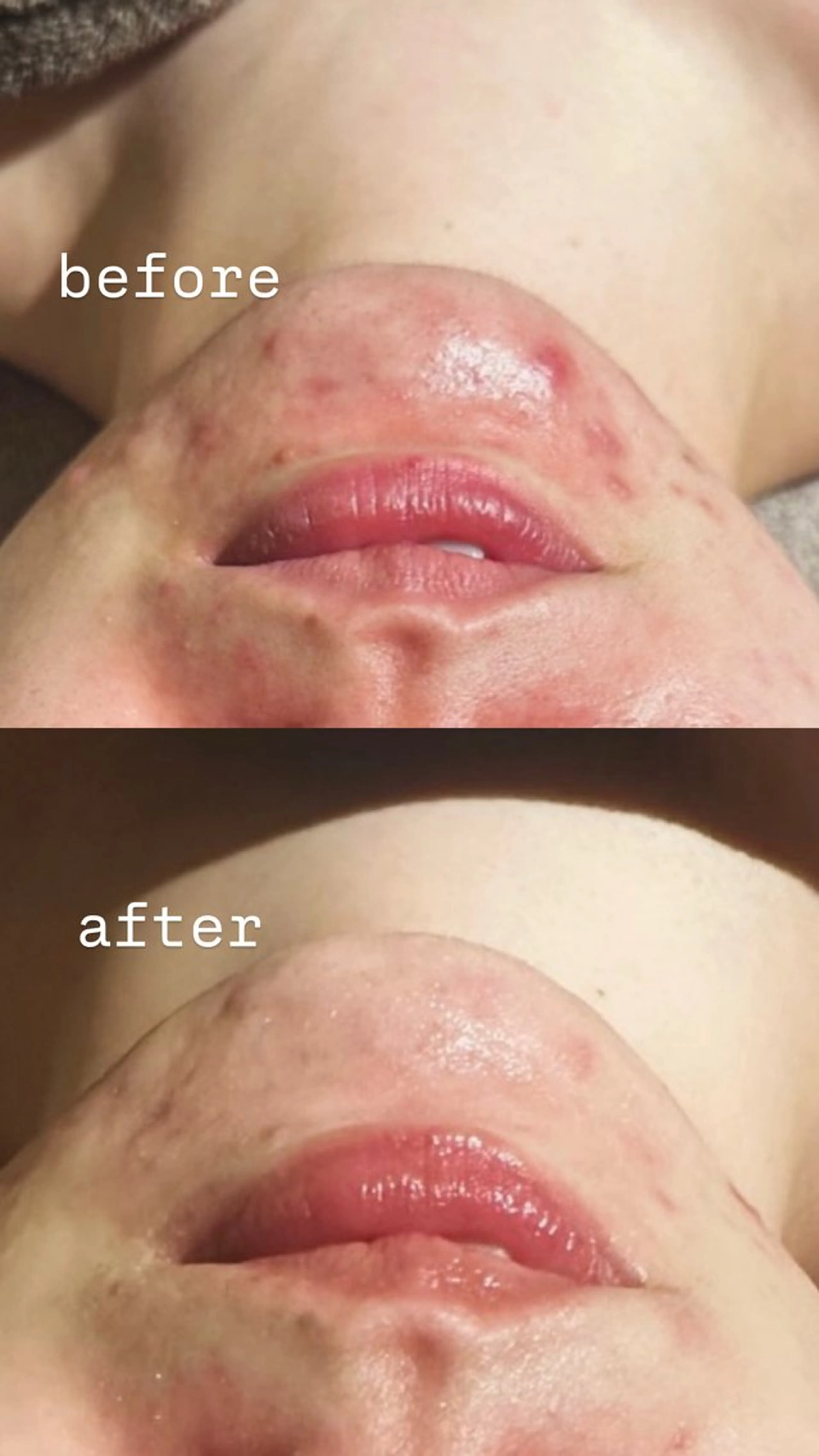 ニキビ・ニキビ跡🌿 ハーブピーリング✨のその他イメージ