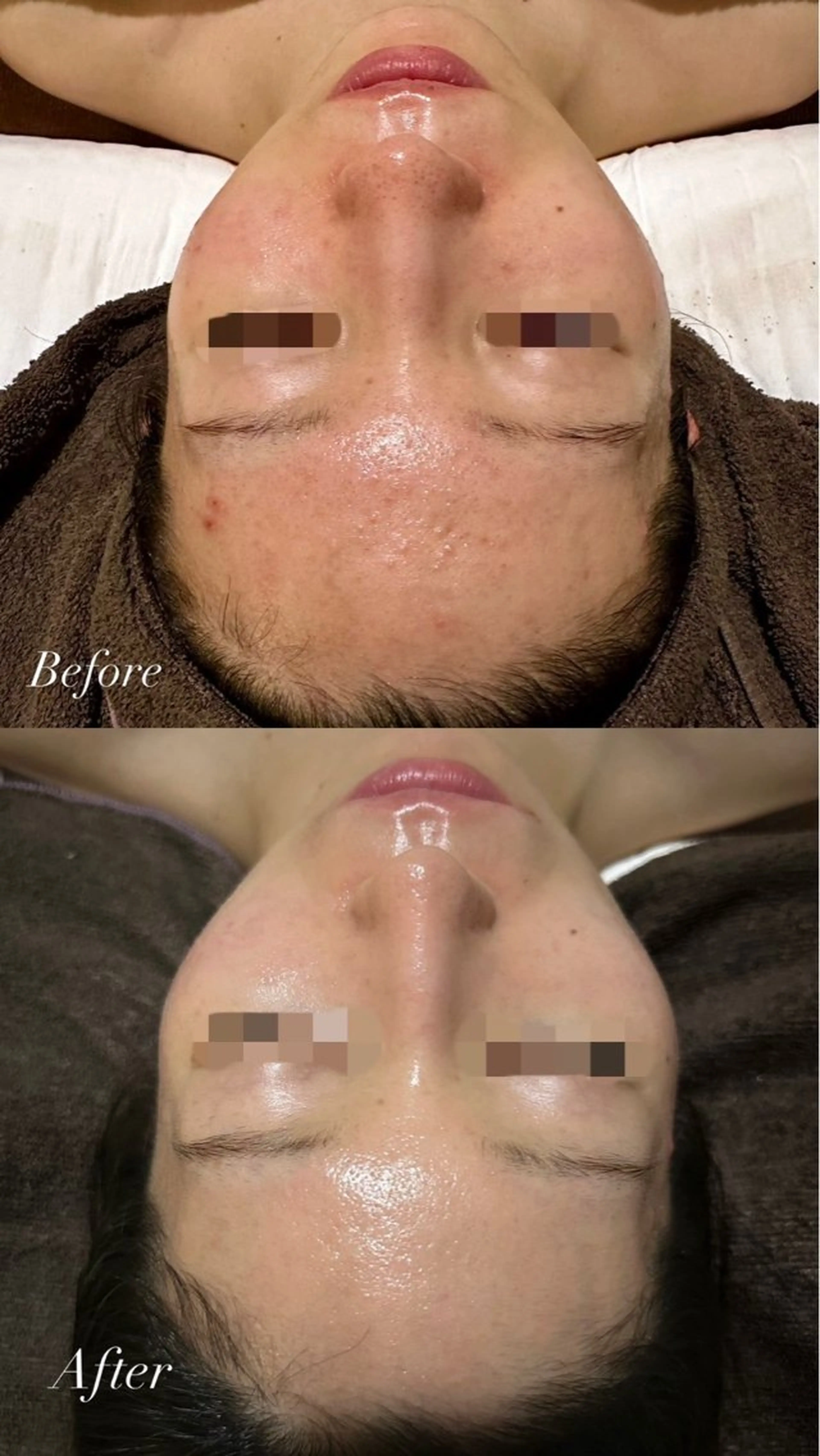 【ニキビ/毛穴改善】人生最後のニキビケア◎剥けないハーブピーリングの写真