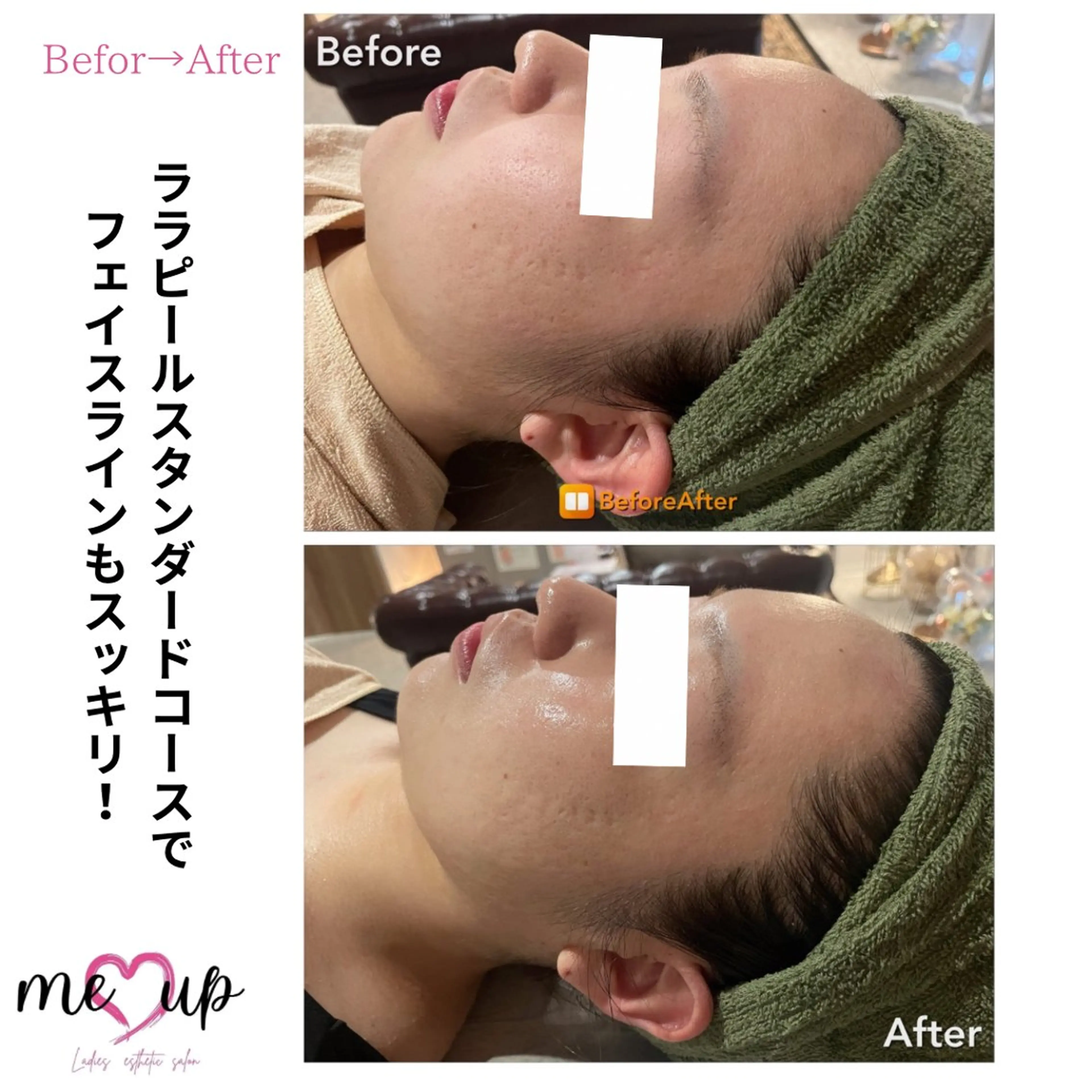 エステ Meupニキビ専門店 背中/ハーブ/肌管理のその他イメージ