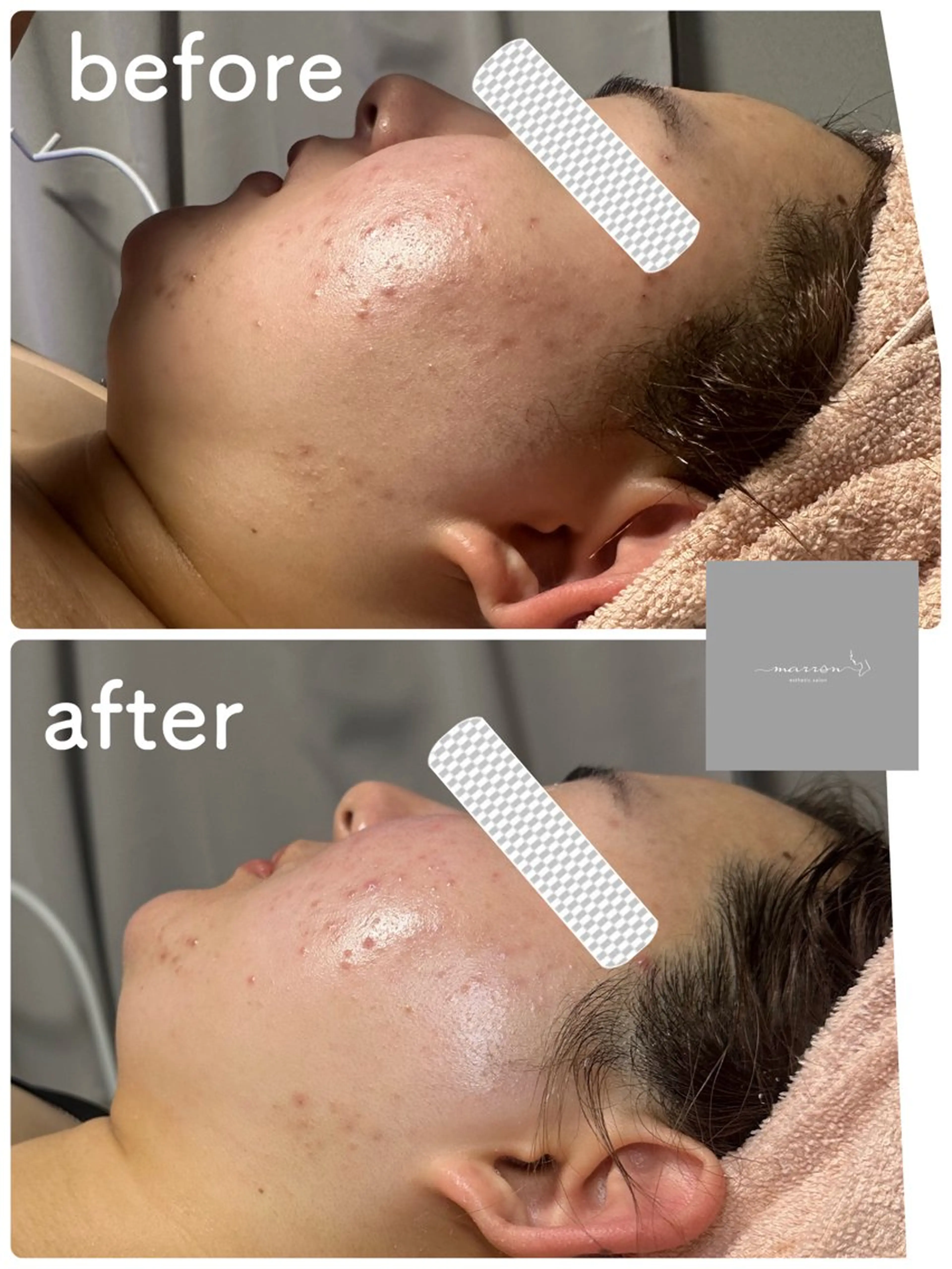 痩身ハイパーナイフ ララピールリアボーテのエステ・リラクイメージ