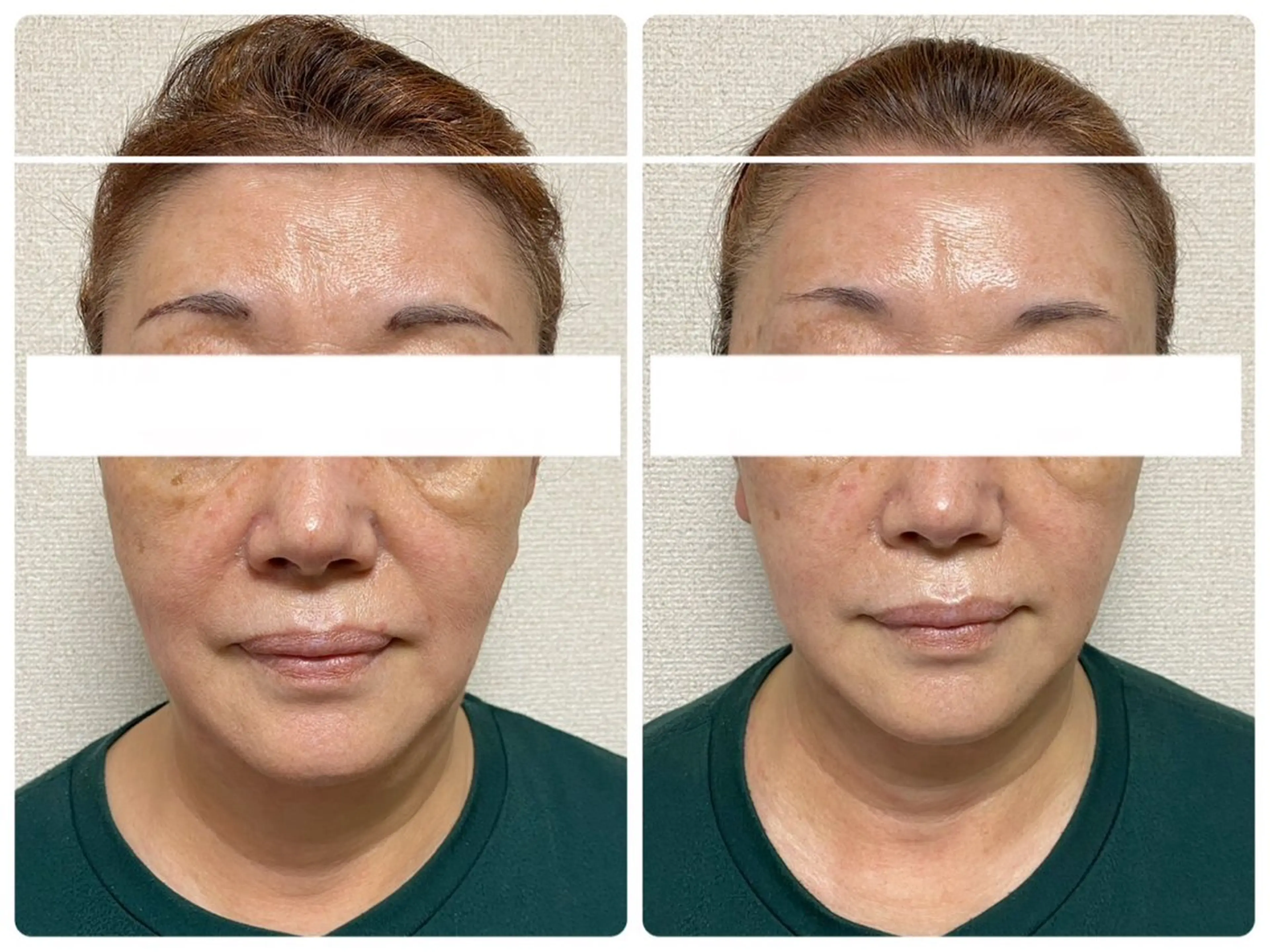 【エイジングケア】最強リフトアップトリートメント❤️当店人気No.1のフェイシャルメニューの写真