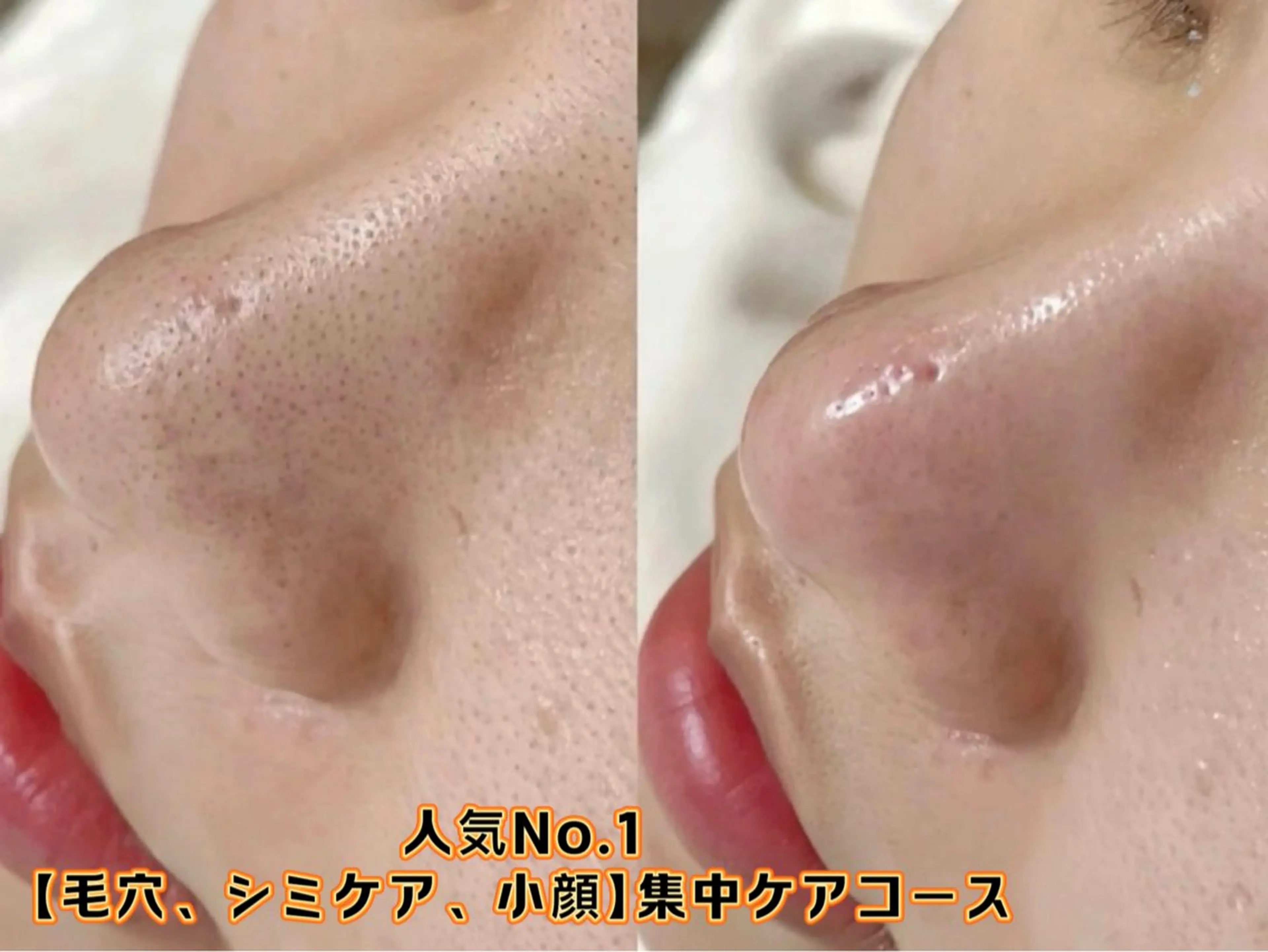 迷ったらこれ⭐︎美容皮膚科をサロン価額で実現⭐︎シミケア小顔☆最新IPL光フェシャル&毛穴洗浄+デコルテ+イオン導入の写真