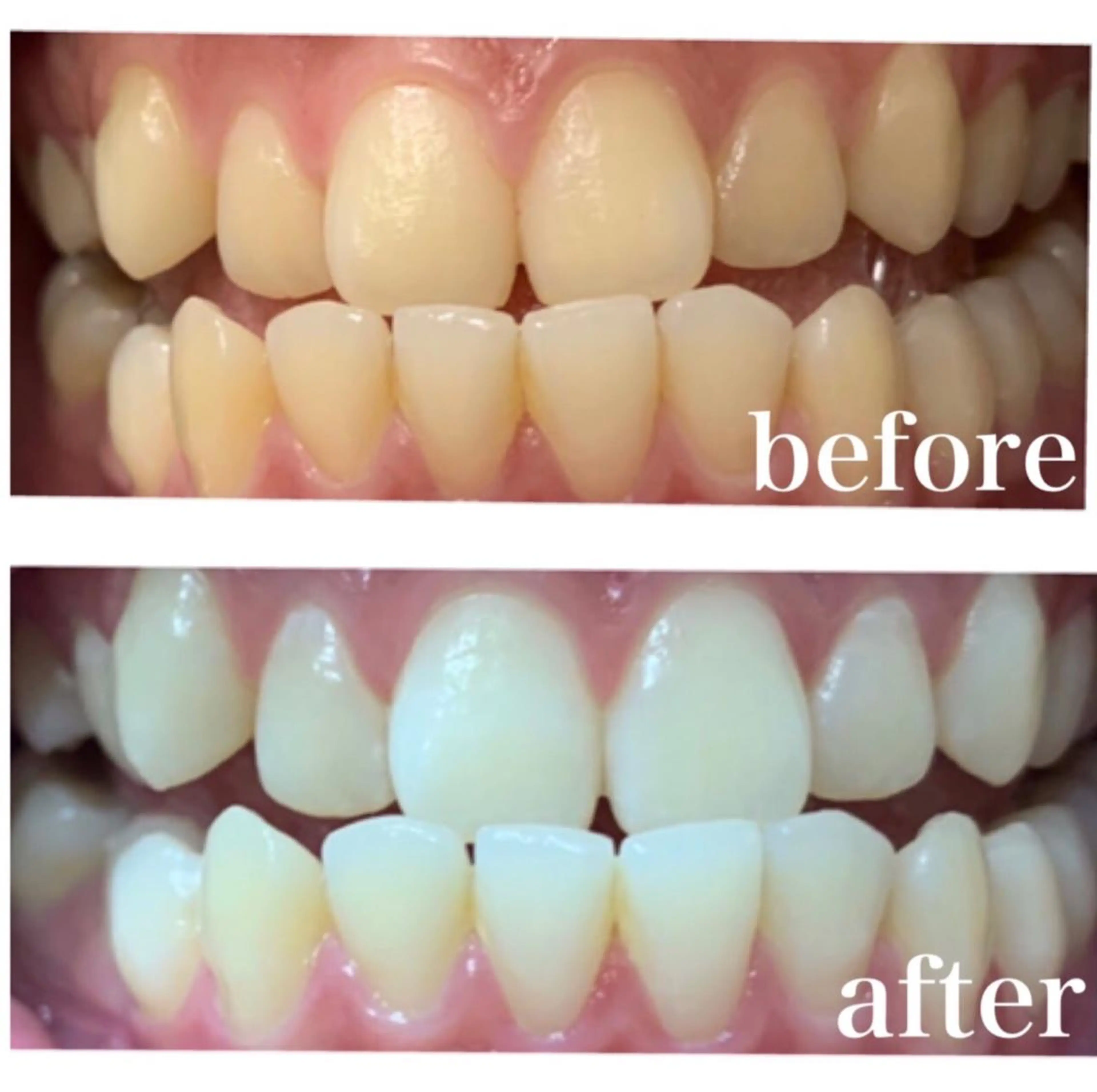 ゴールドプラン🦷✨透明感と輝きのある自然な白さに♪8×3照射5,980円の写真