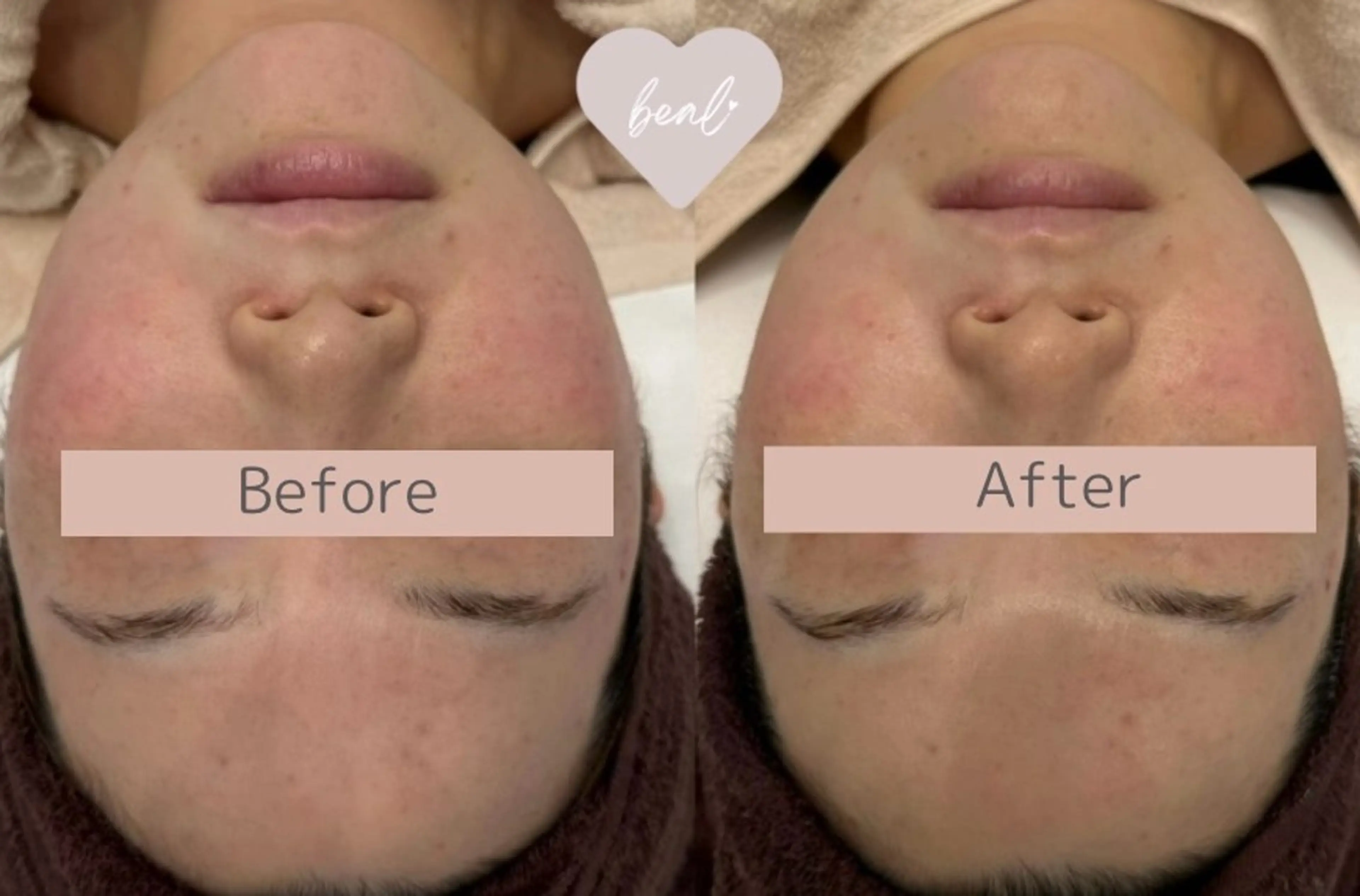 小顔/毛穴/ニキビ salon bealのエステ・リラクイメージ