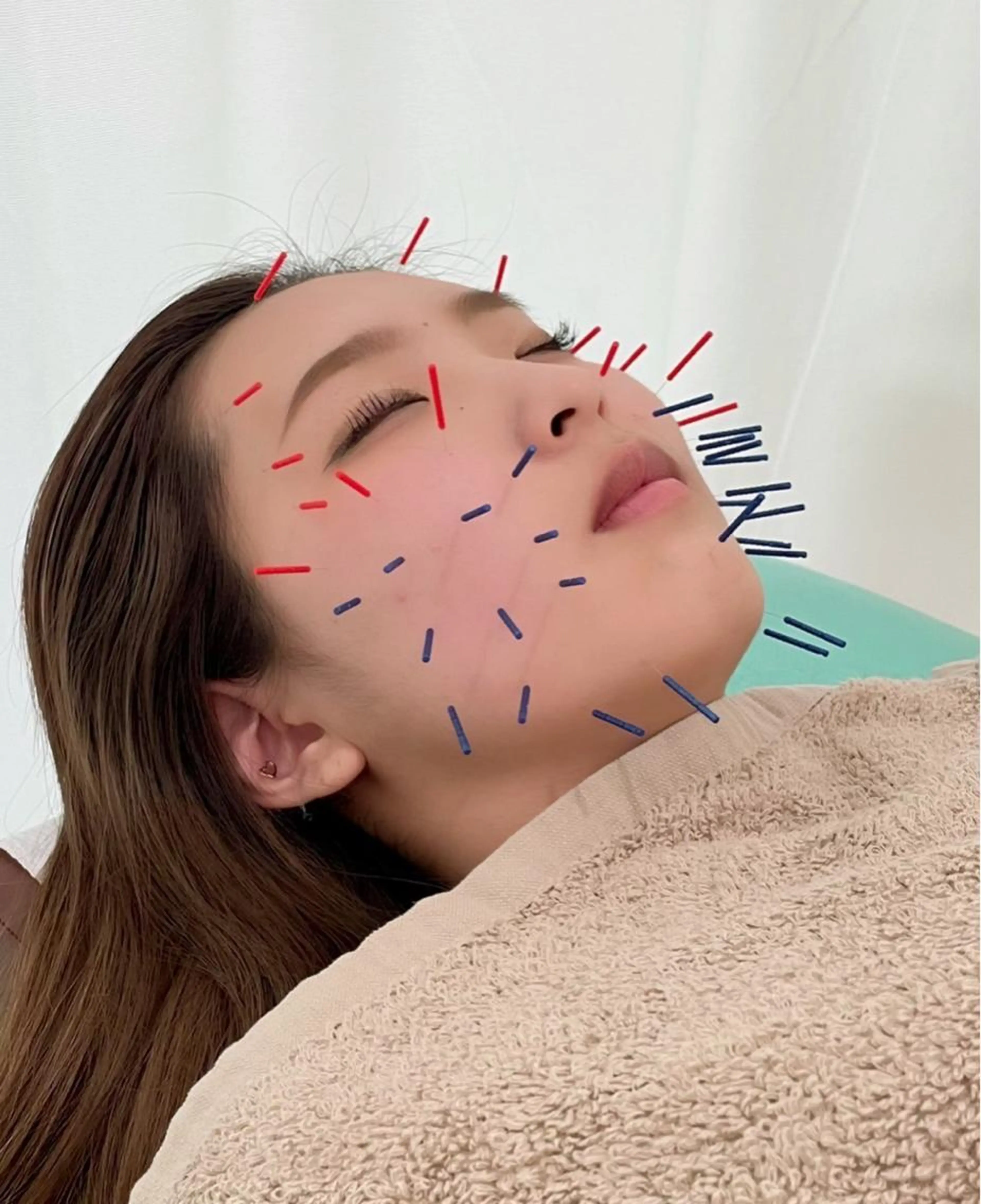 【今話題の美容鍼✨】美容鍼➕パルス電気鍼でむくみゼロのすっきり小顔に⭐️(カウンセリング込)の写真