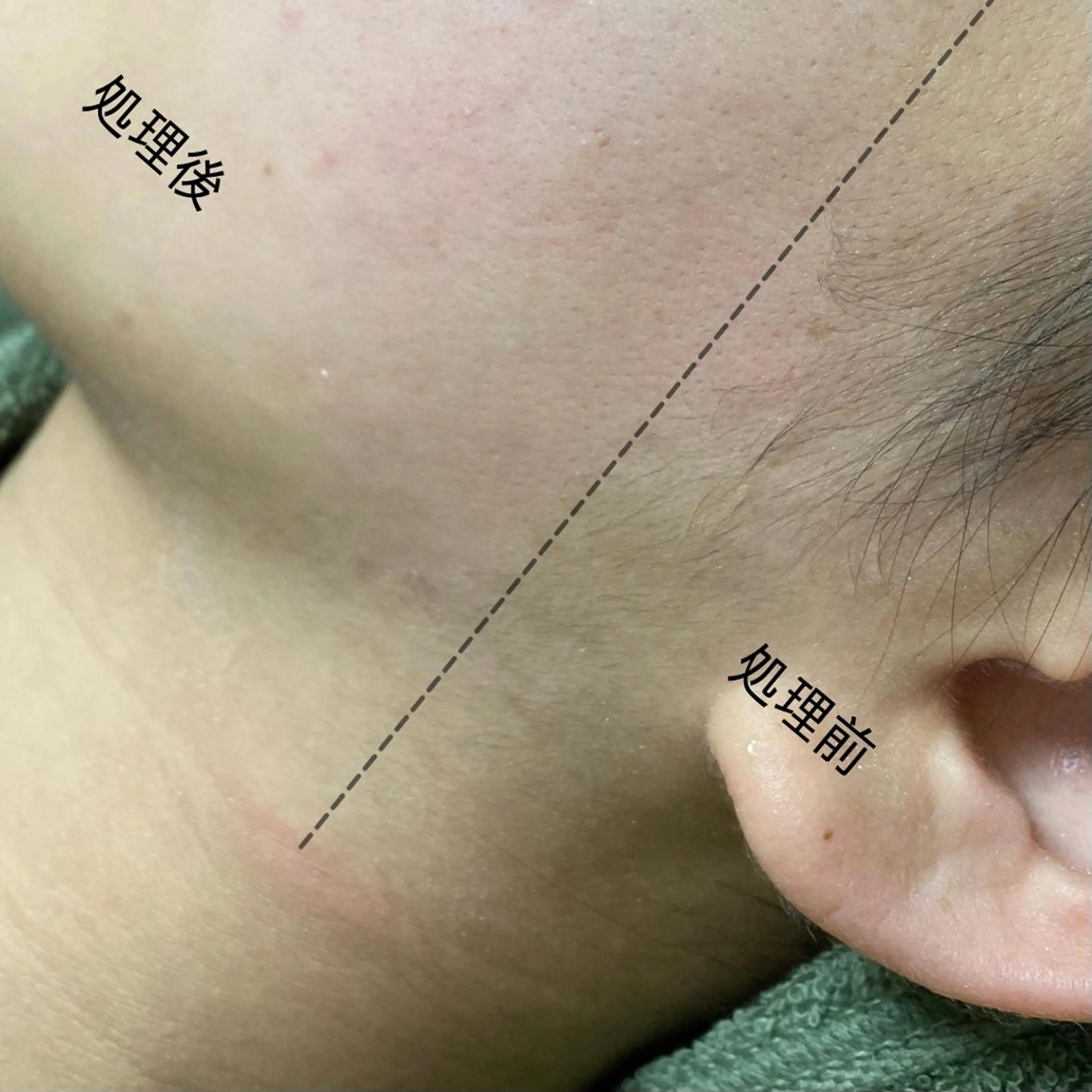 脱毛 Ohata Megumiの眉毛・アイブロウイメージ