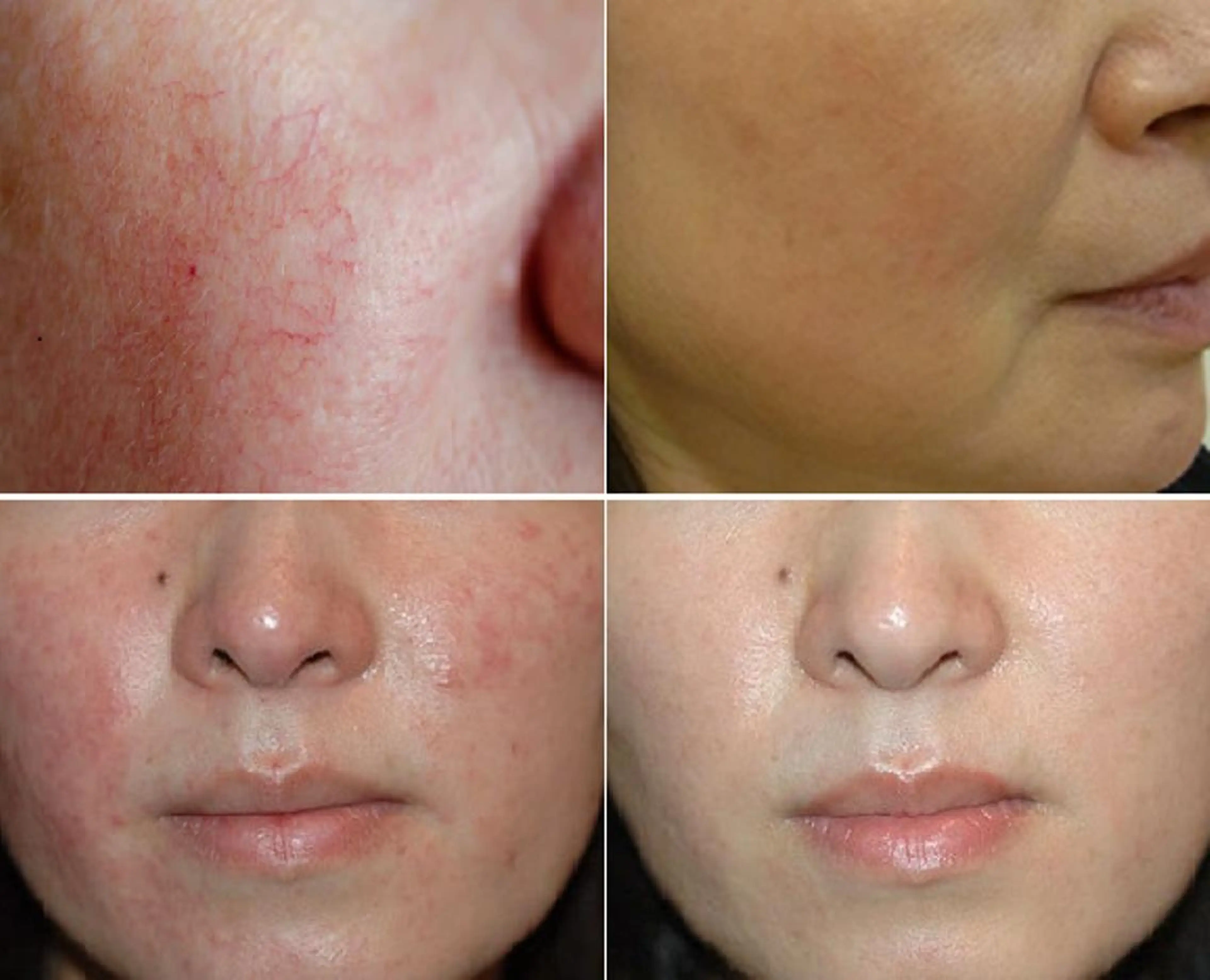 エステ 顔脱毛&毛穴&ニキビ 優良№1♪ヒロコ♪のエステ・リラクイメージ