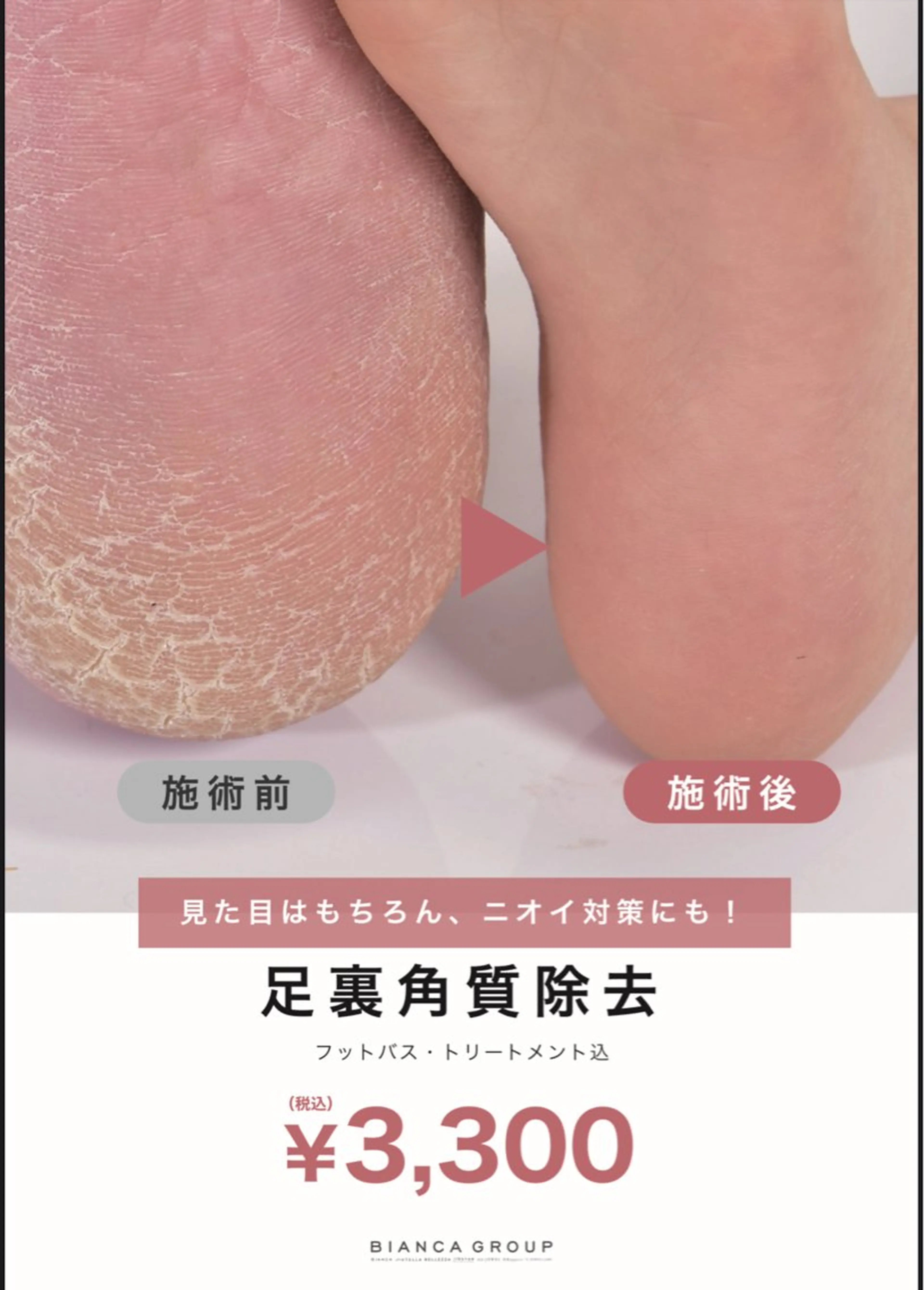 [フットケア]角質除去でグッバイかさかさ🫧フットバス･保湿🫧ツルツルかかとで夏を楽しみませんか🌴高円寺/阿佐ヶ谷の写真